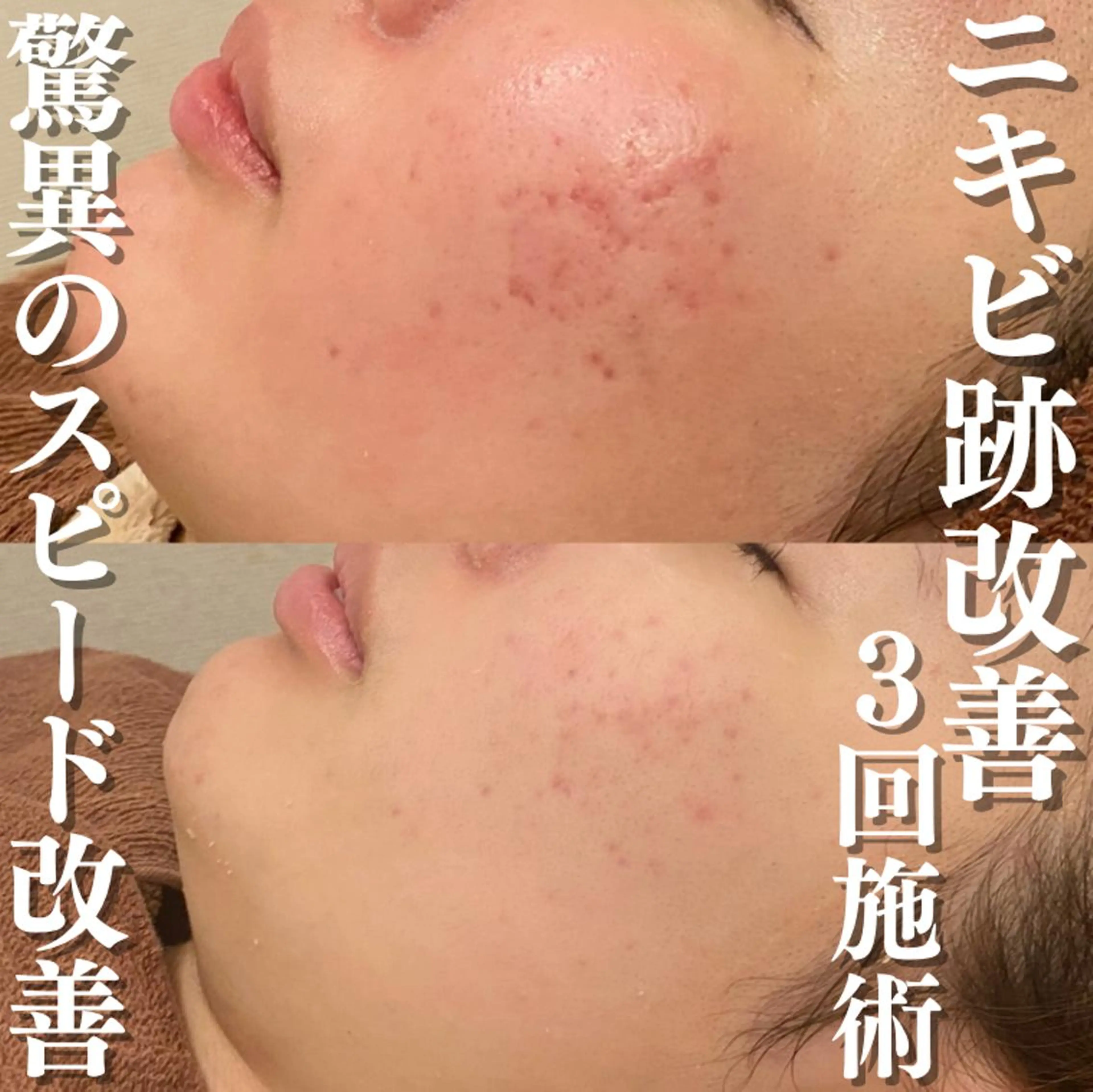 🔥3か月で肌革命 🔥ニキビ専門店のエステ・リラクイメージ