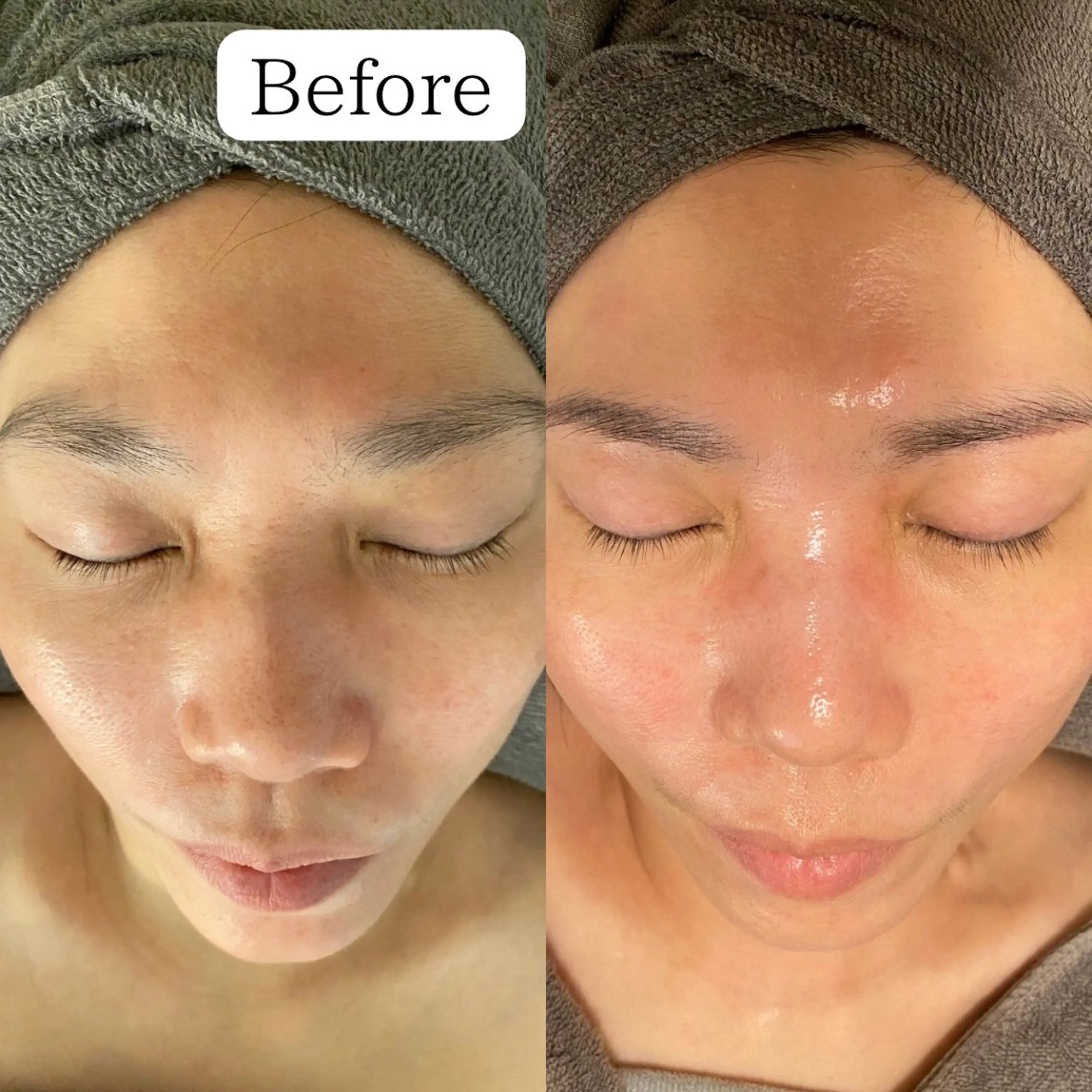 【シワ、ハリにはコレ】たるみ改善🫧炭酸コースの写真