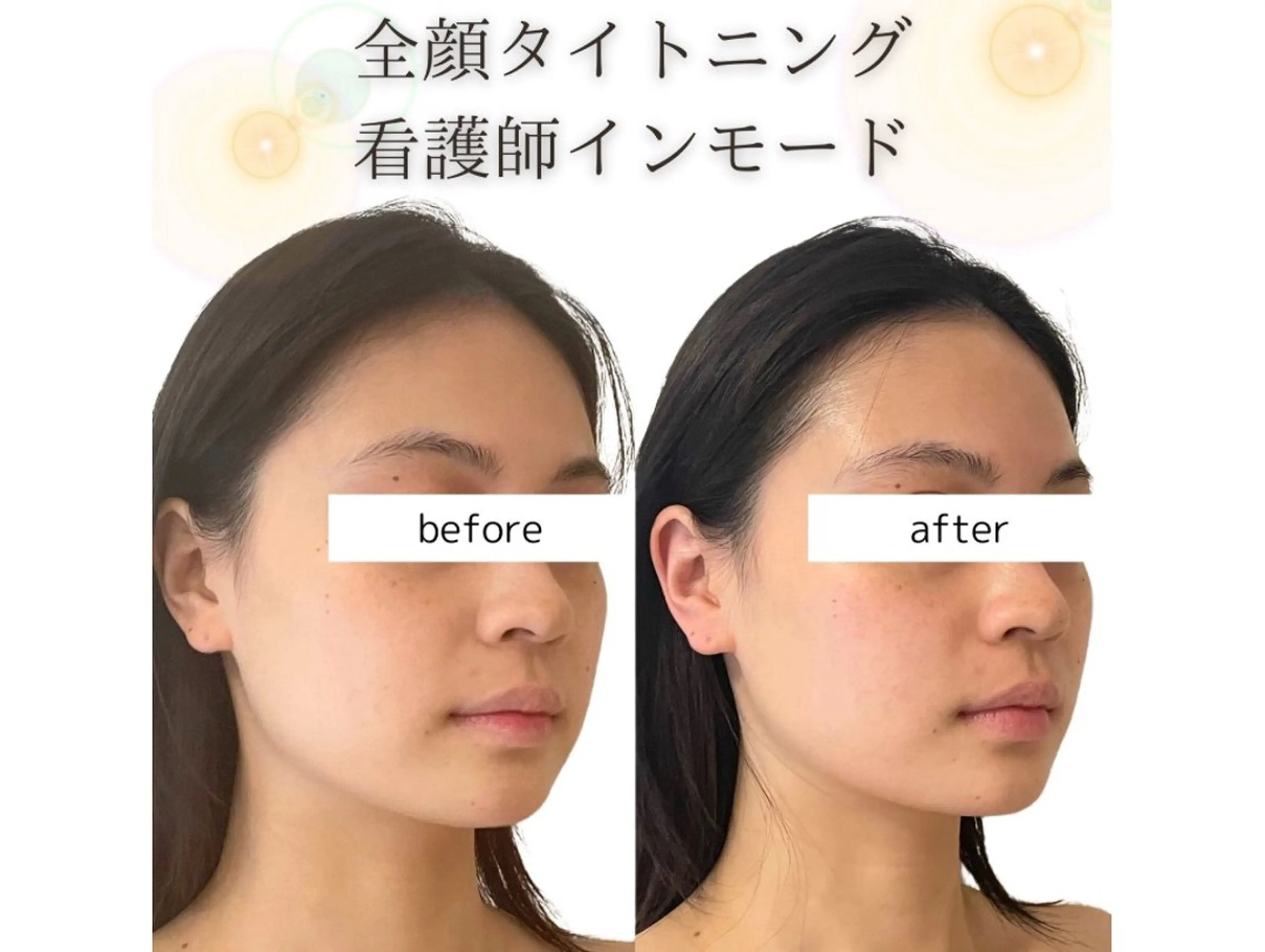 エステ 小顔/たるみ/黒ずみ除去専門サロン/SONA 大和西大寺店所属・【小顔専門看護師 サロンSONA】のエステ・リラクイメージ