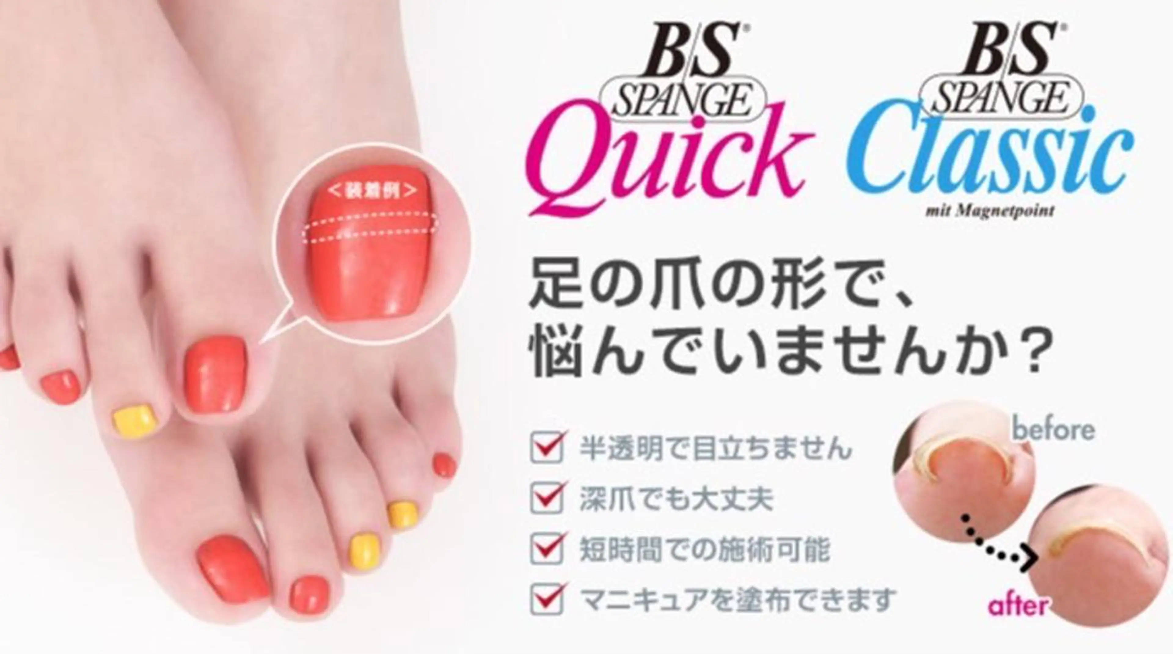 🦶巻き爪矯正🦶1本¥3500💖2本¥6500💖の写真