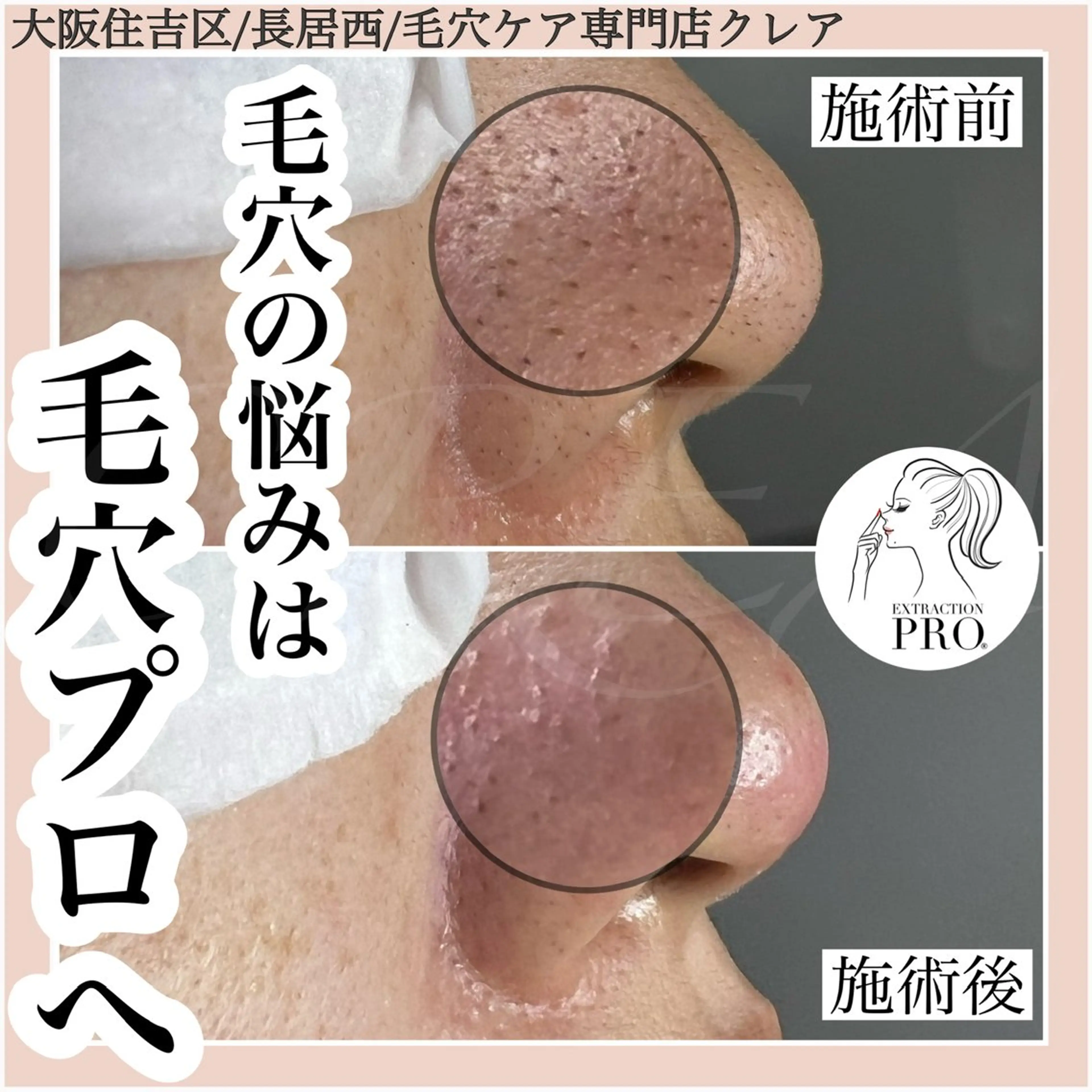 《ミニモ学割》U24  【お試し毛穴ケア👃✨】毛穴のお悩み解消！黒ずみ・いちご鼻・つまった角栓もお任せください！の写真