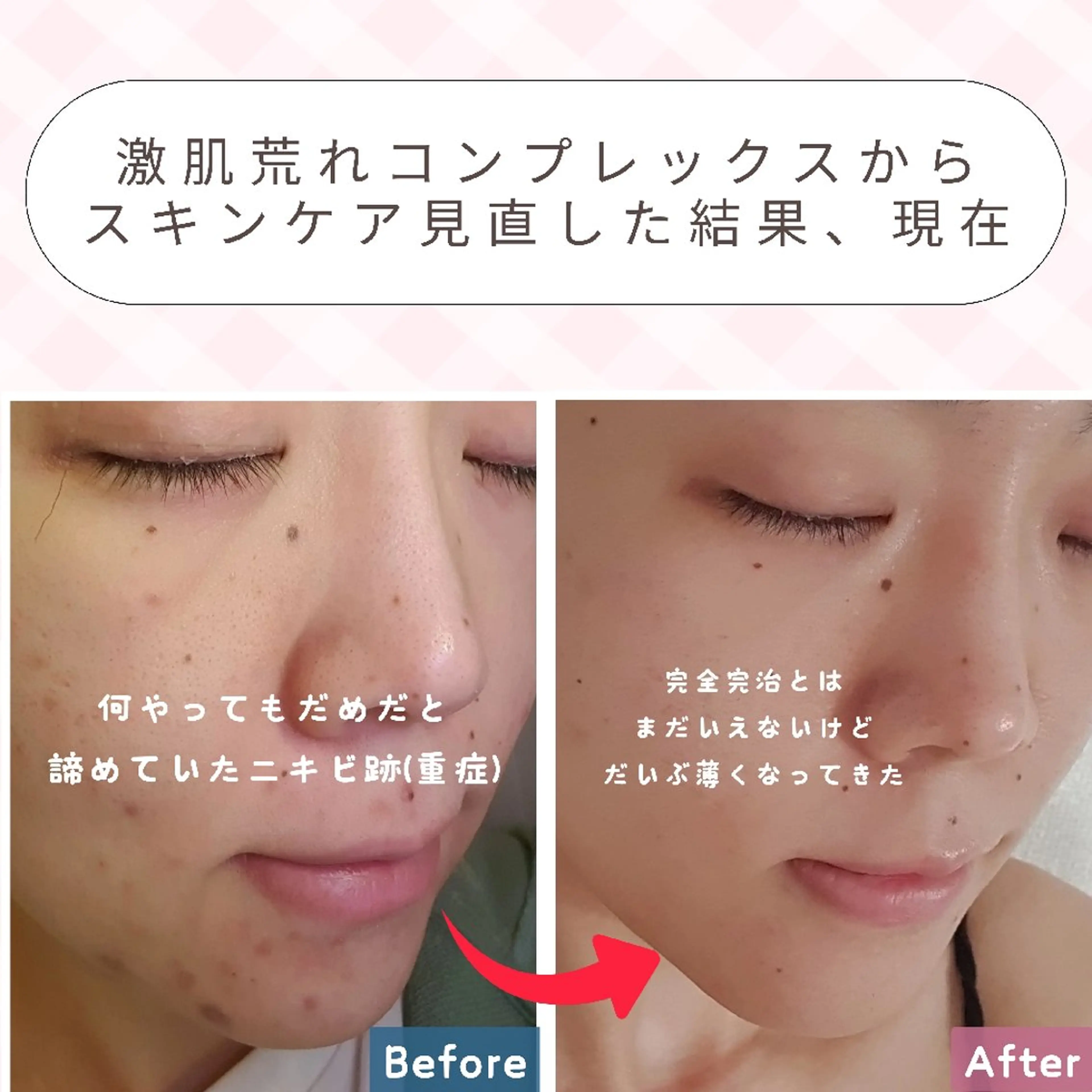 エステ リラク 痩身ハーブピーリング 筋膜リリース☆B&Hのエステ・リラクイメージ
