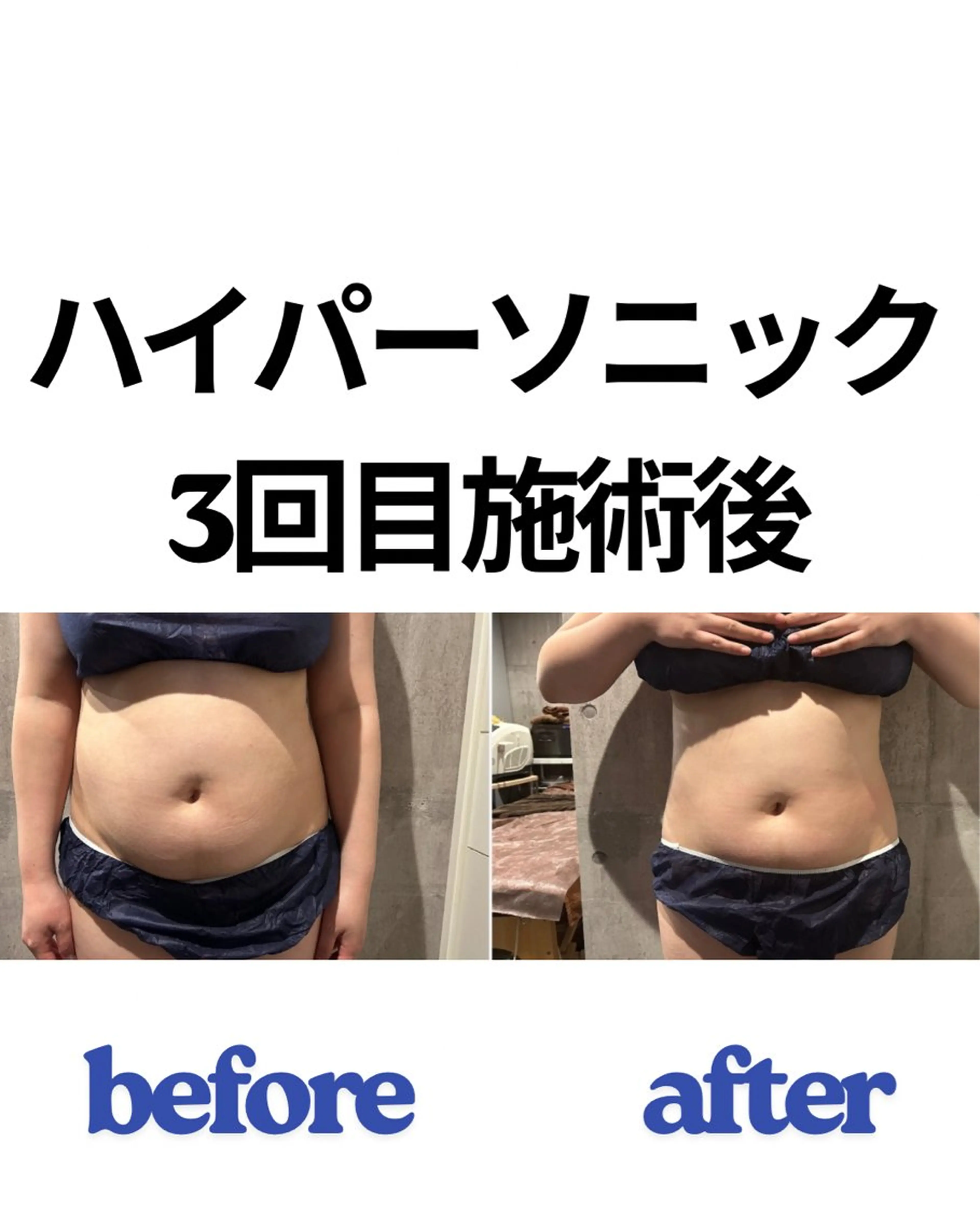Body痩せ​〜​痩身​〜​最新マシンハイパーソニック！施術後の実感95%以上⭐︎コースなし、都度払い🉐衝撃の効果😳✨の写真