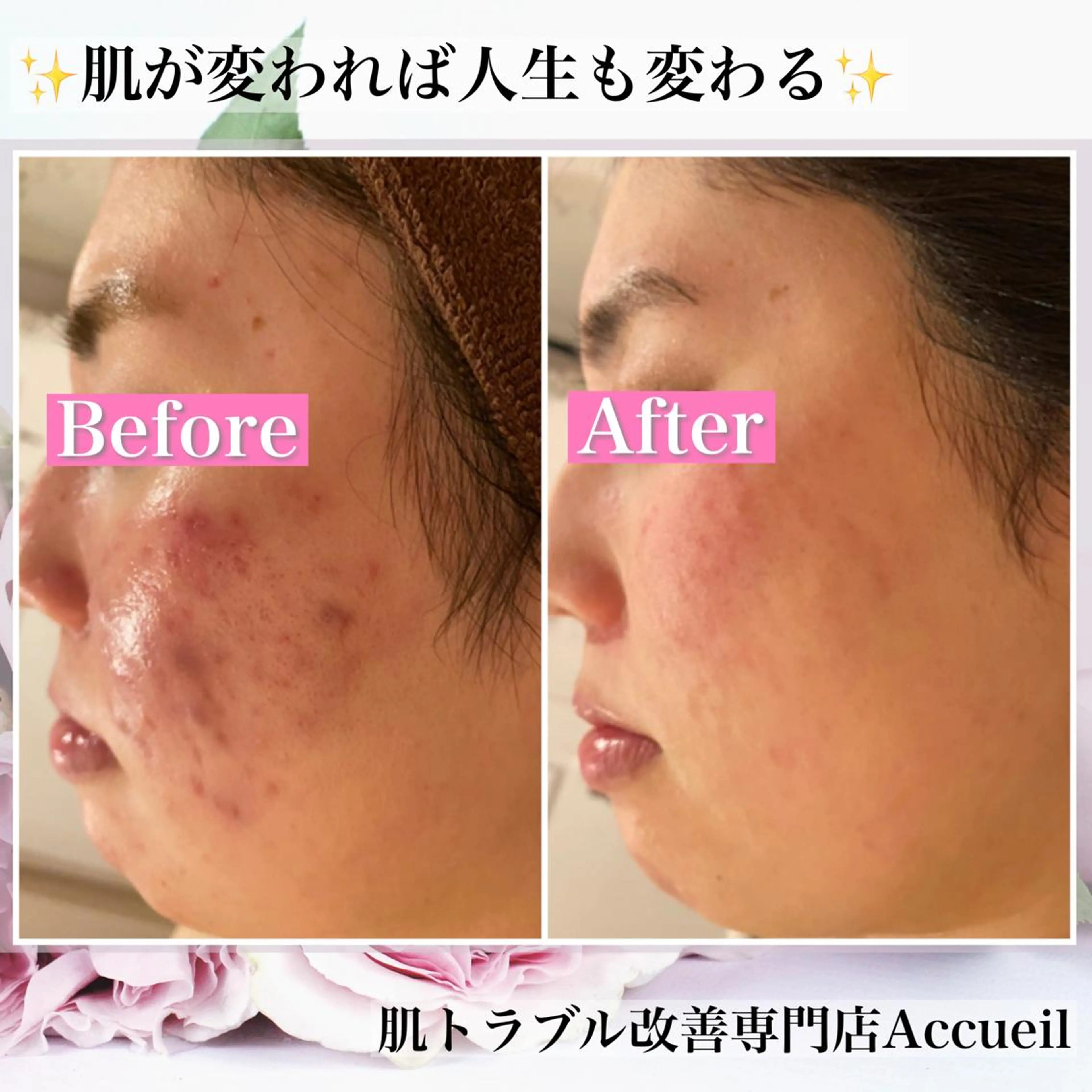 ミディアム カラー パーマ ヘアアレンジ メンズ キッズ ネイル マツエク・マツパ アイブロウ エステ リラク アクール　齋藤 ♡肌トラブル卒業のエステ・リラクイメージ