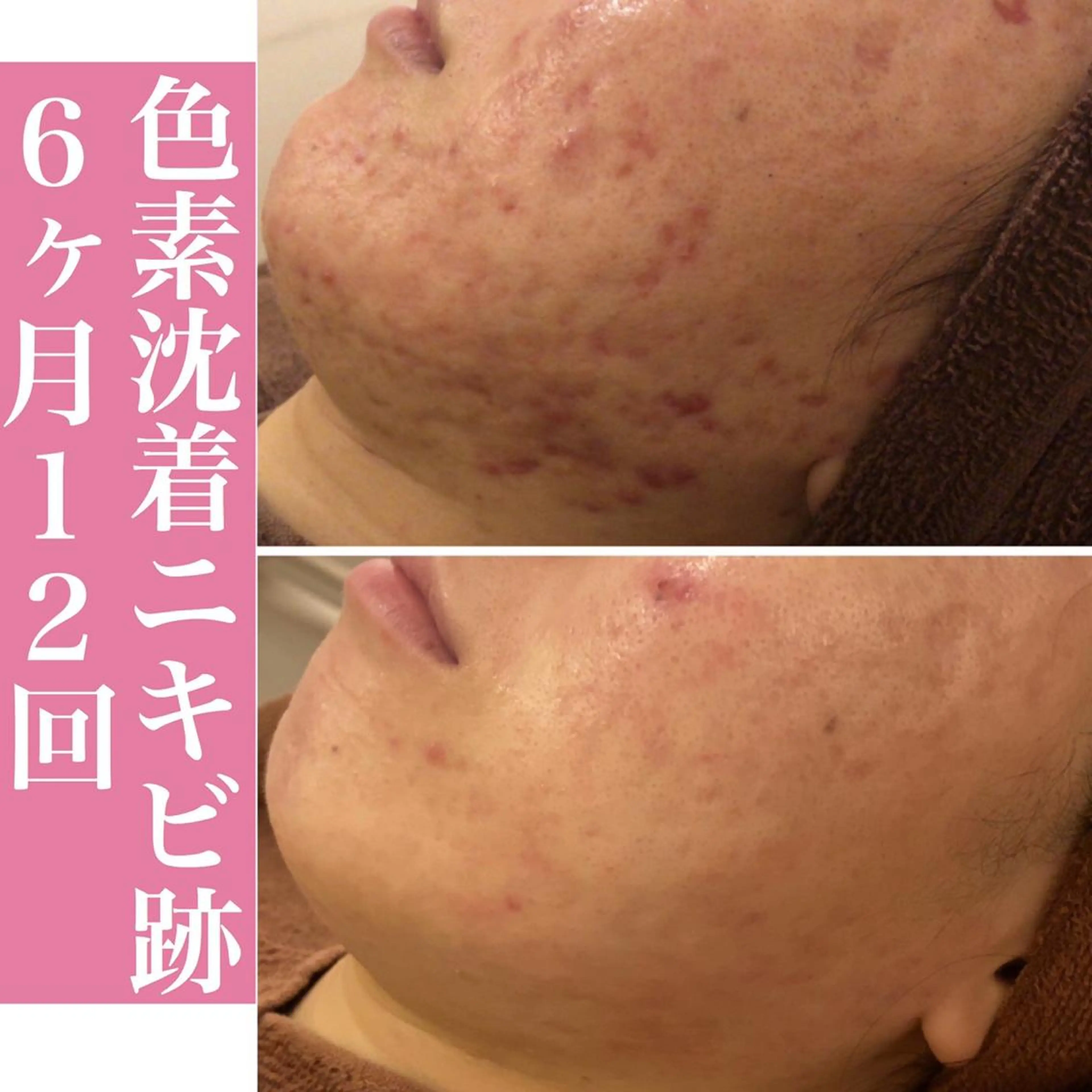 ミディアム カラー パーマ ヘアアレンジ メンズ キッズ ネイル マツエク・マツパ アイブロウ エステ リラク アクール　齋藤 ♡肌トラブル卒業のエステ・リラクイメージ