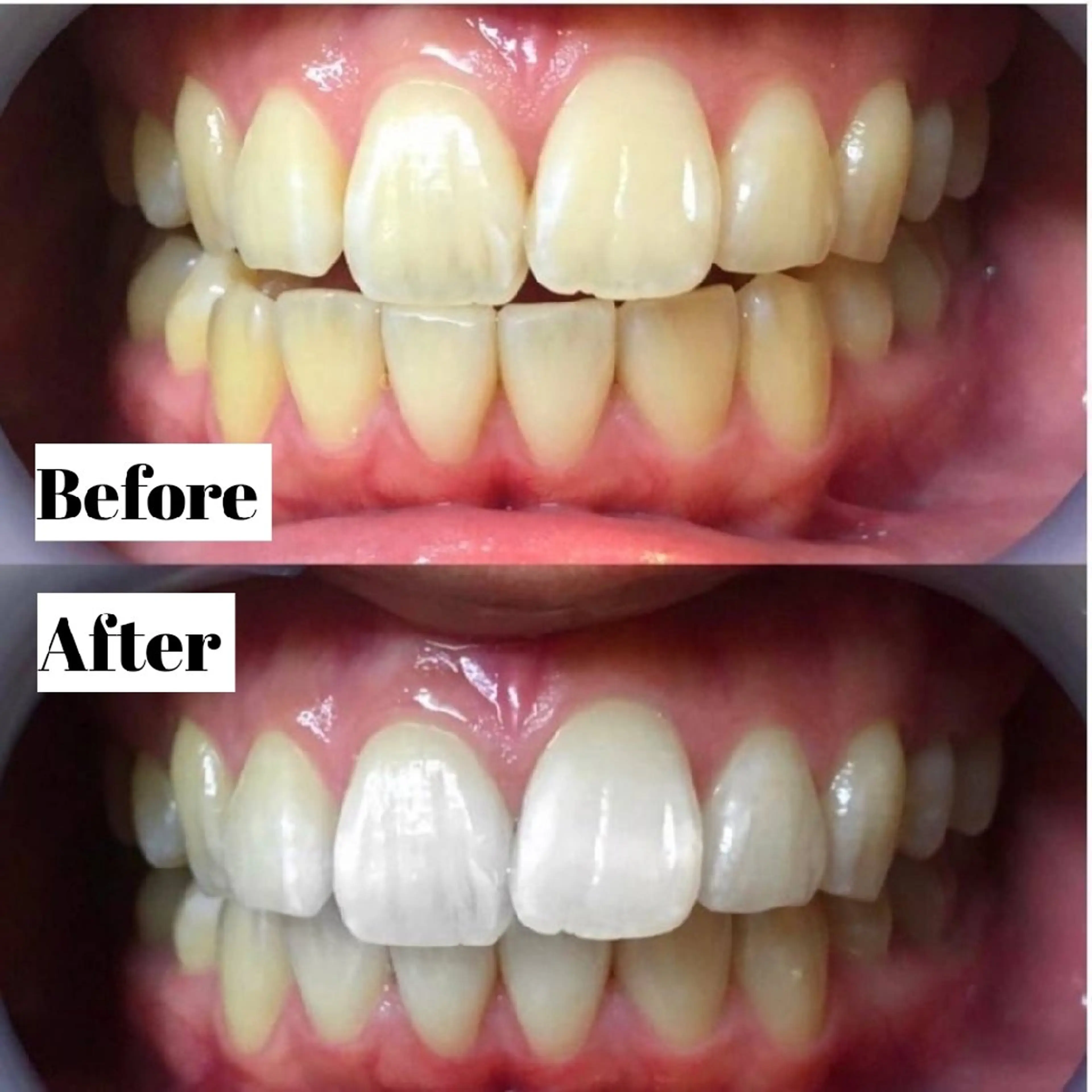 【⚜️チケット会員様⚜️】専用メニュー🦷✨ハイパワー4回照射の写真