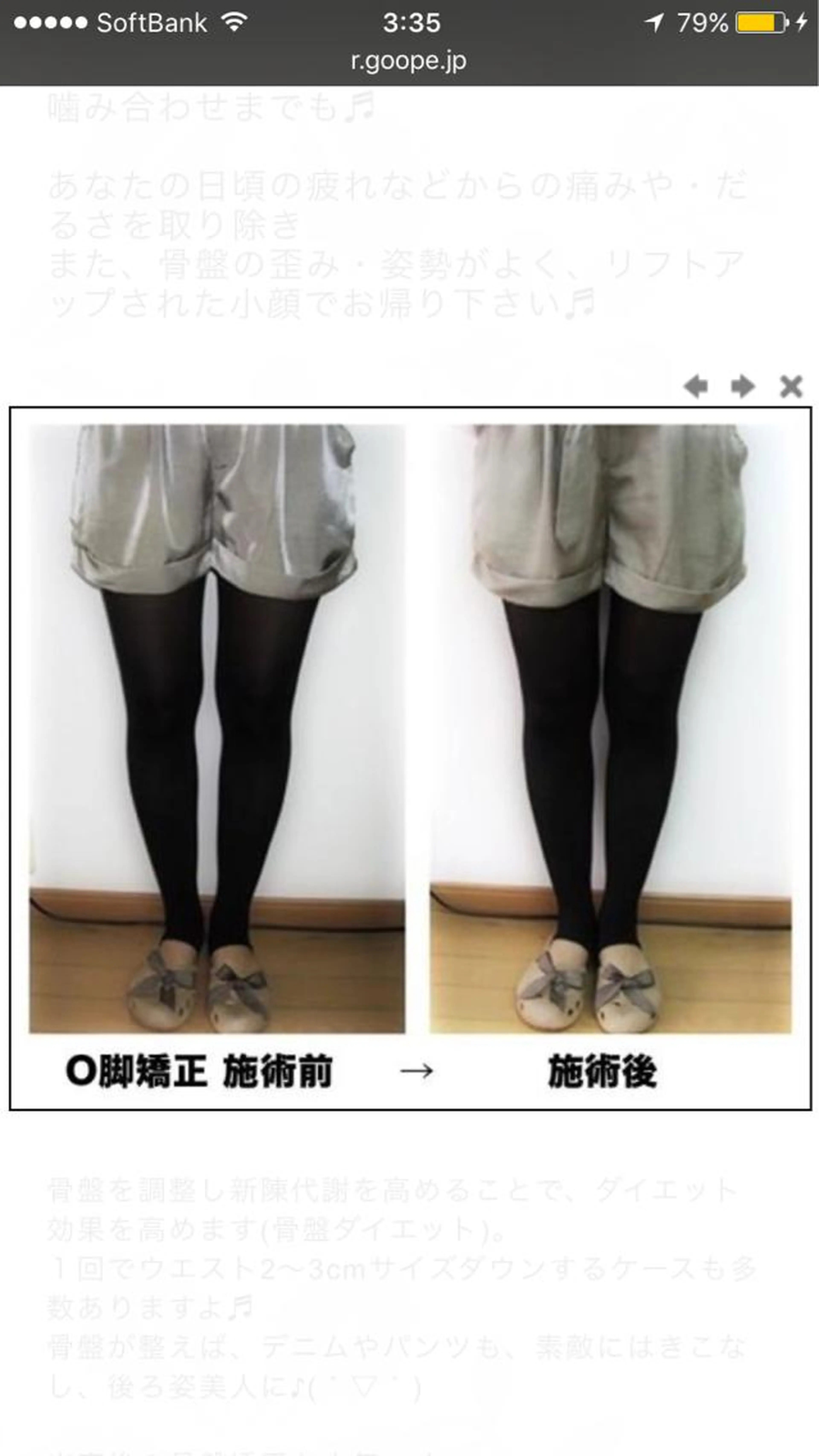 骨盤・O脚矯正の写真