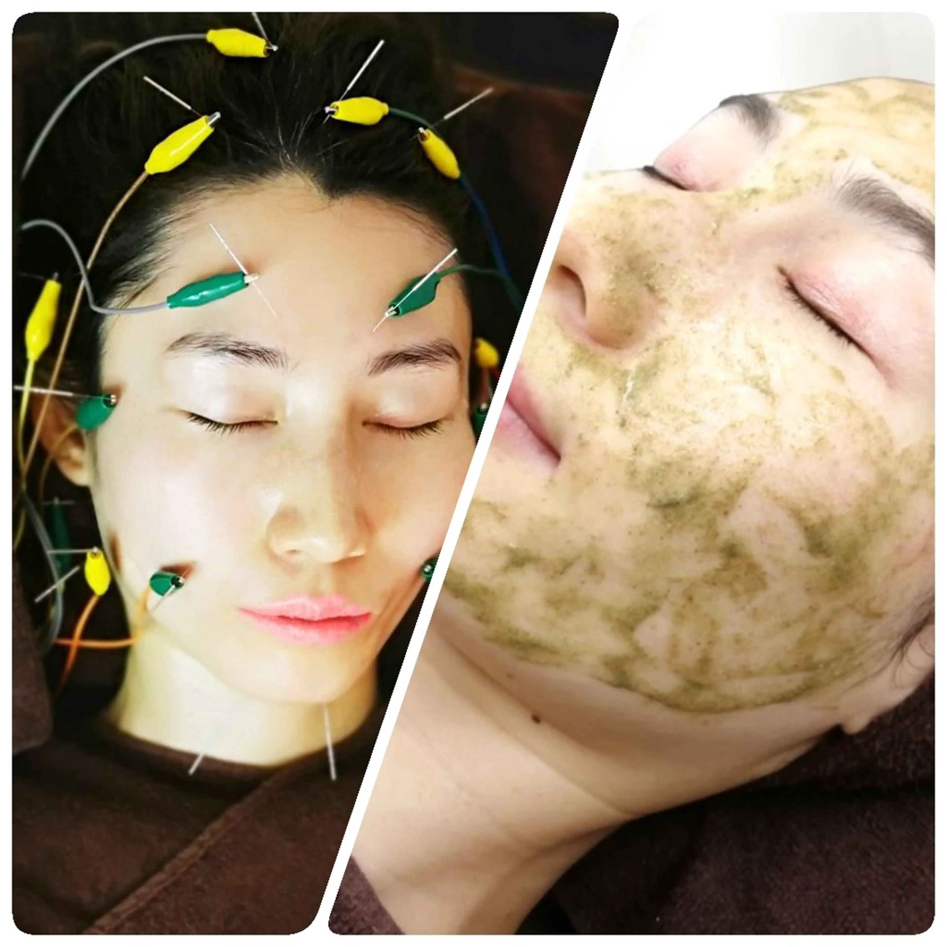 【透明感・ざらつき・ツヤ肌】ハーブピーリング🌿+電気を20ヶ所も流す美容鍼🪡【ニューハーフ鍼灸師の最強肌管理🌹】の写真