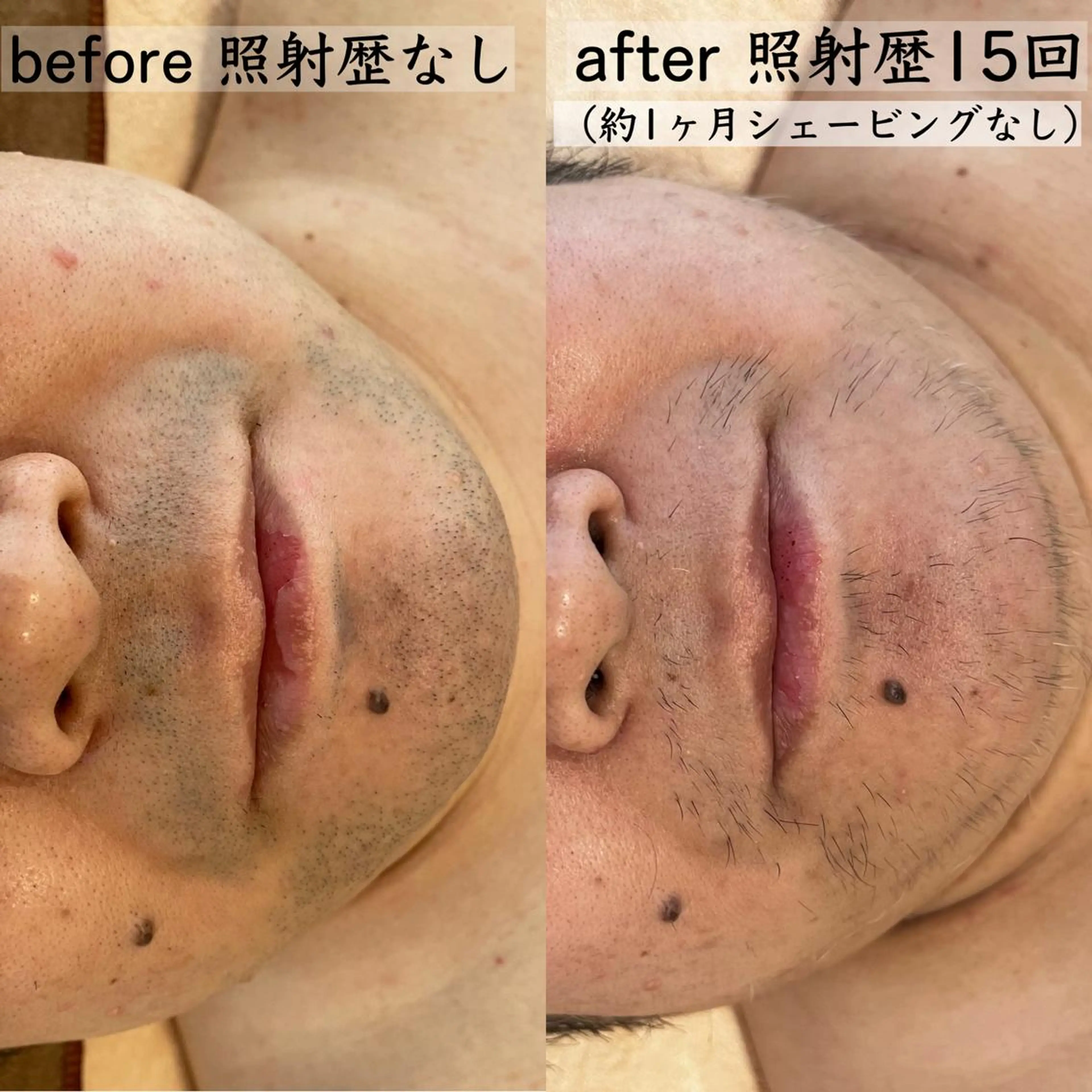 メンズ 脱毛 美肌コラーゲン脱毛SINCERITE【サンセリテ】所属・瀬野 のぞみのエステ・リラクイメージ