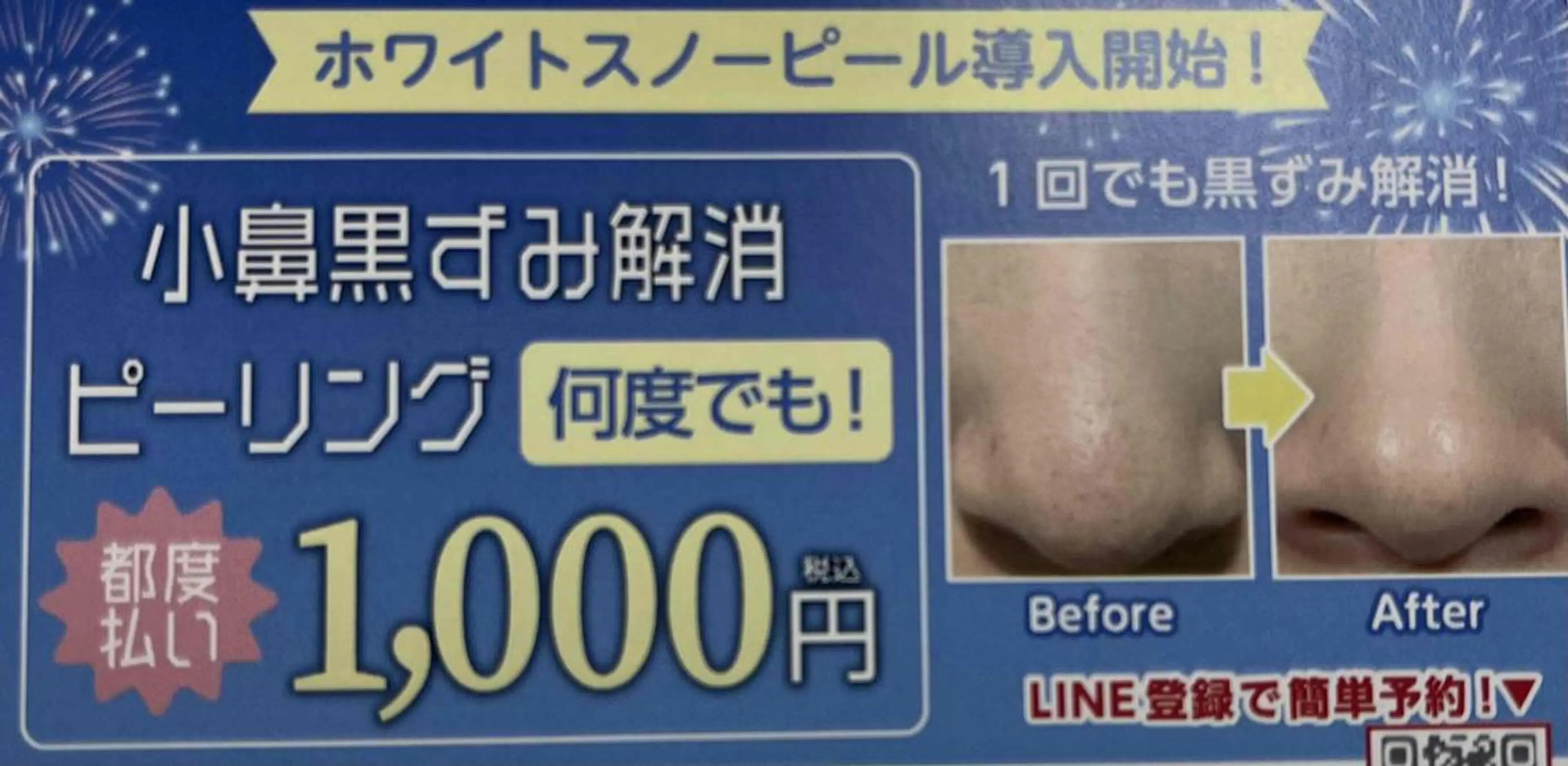 小鼻黒ずみ解消ピーリング　都度1回の写真