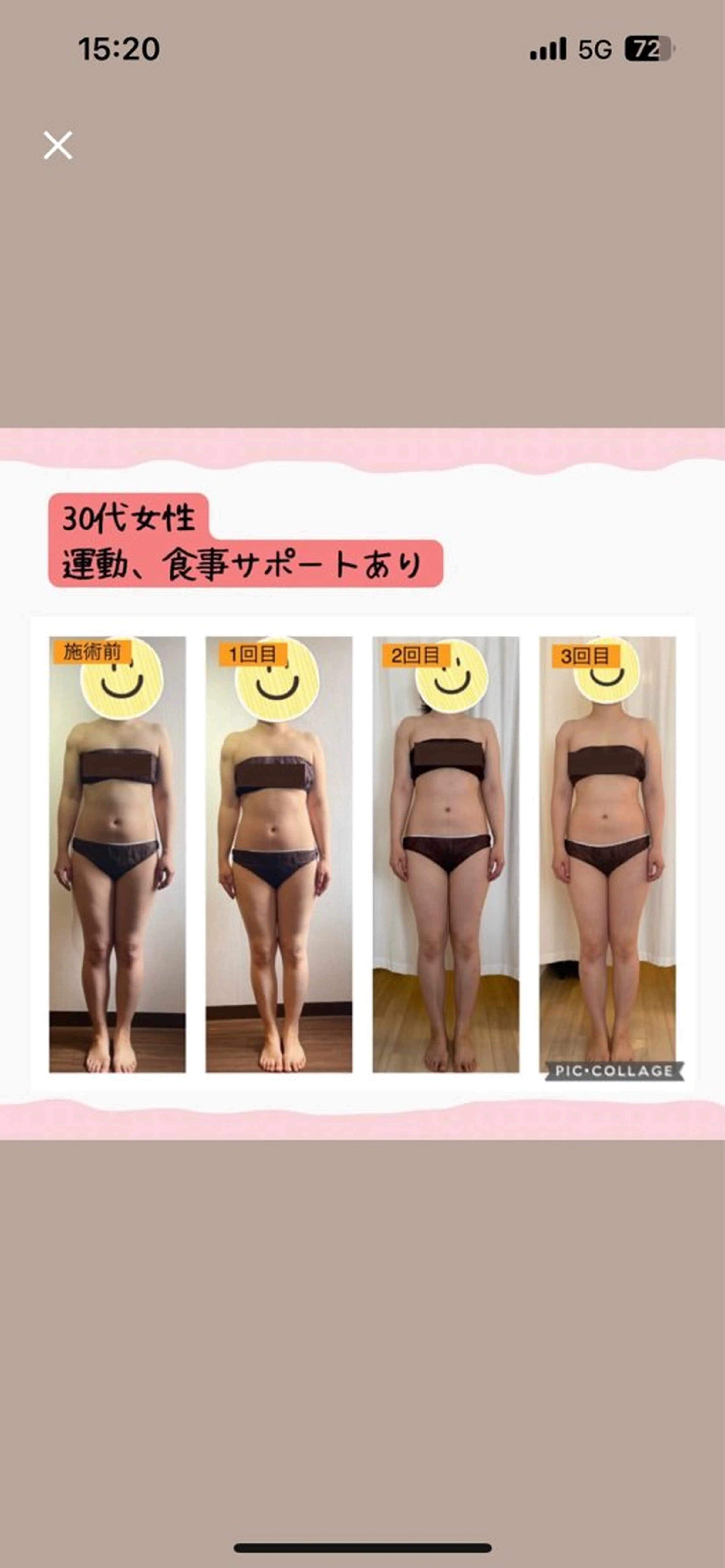 🌀【minimo限定】セルライト除去コース（75分）の写真