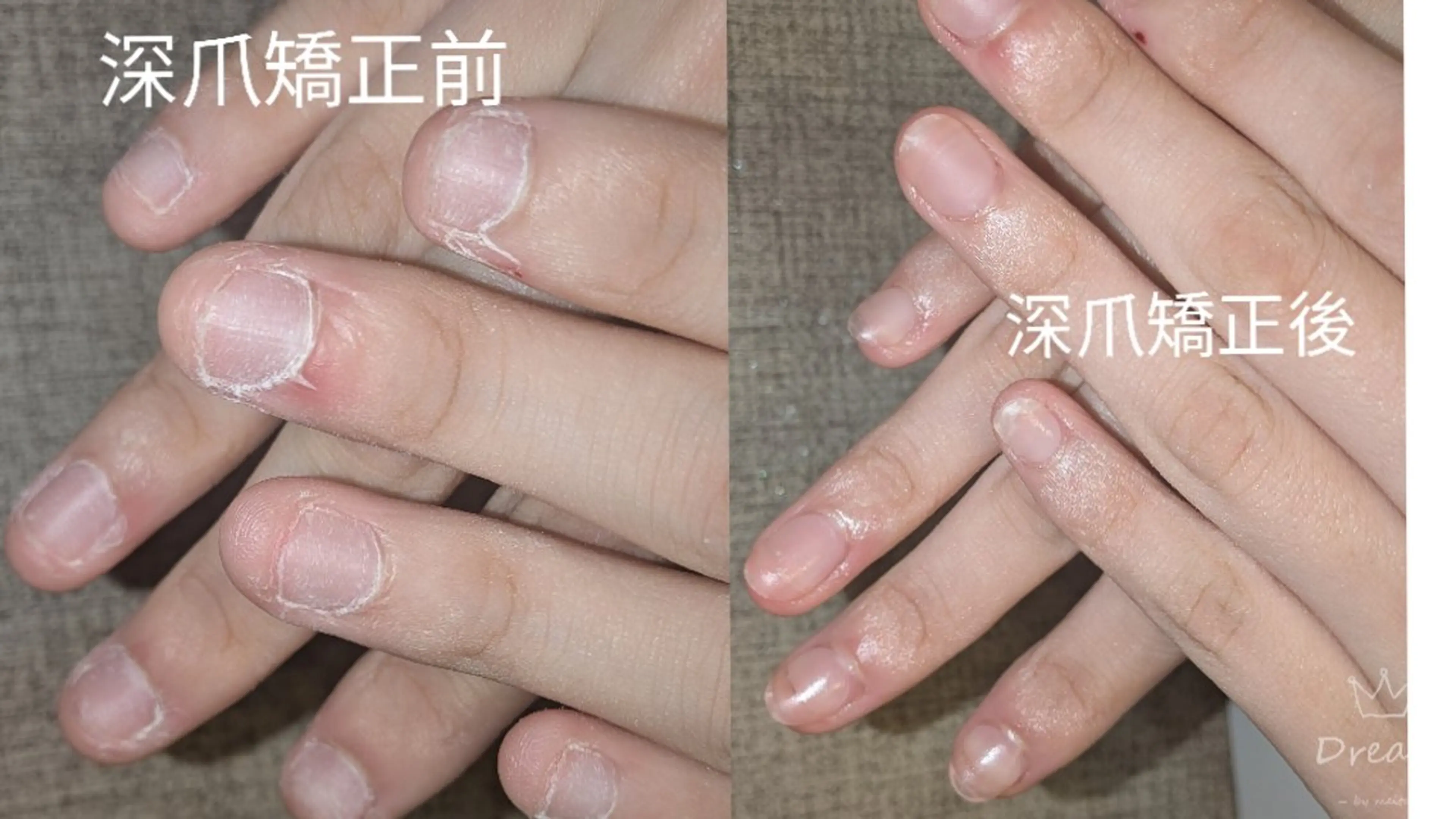 ネイル ハンドネイル ハンドケア ネイリストゆか💅 長さだし、深爪矯正のネイルデザイン
