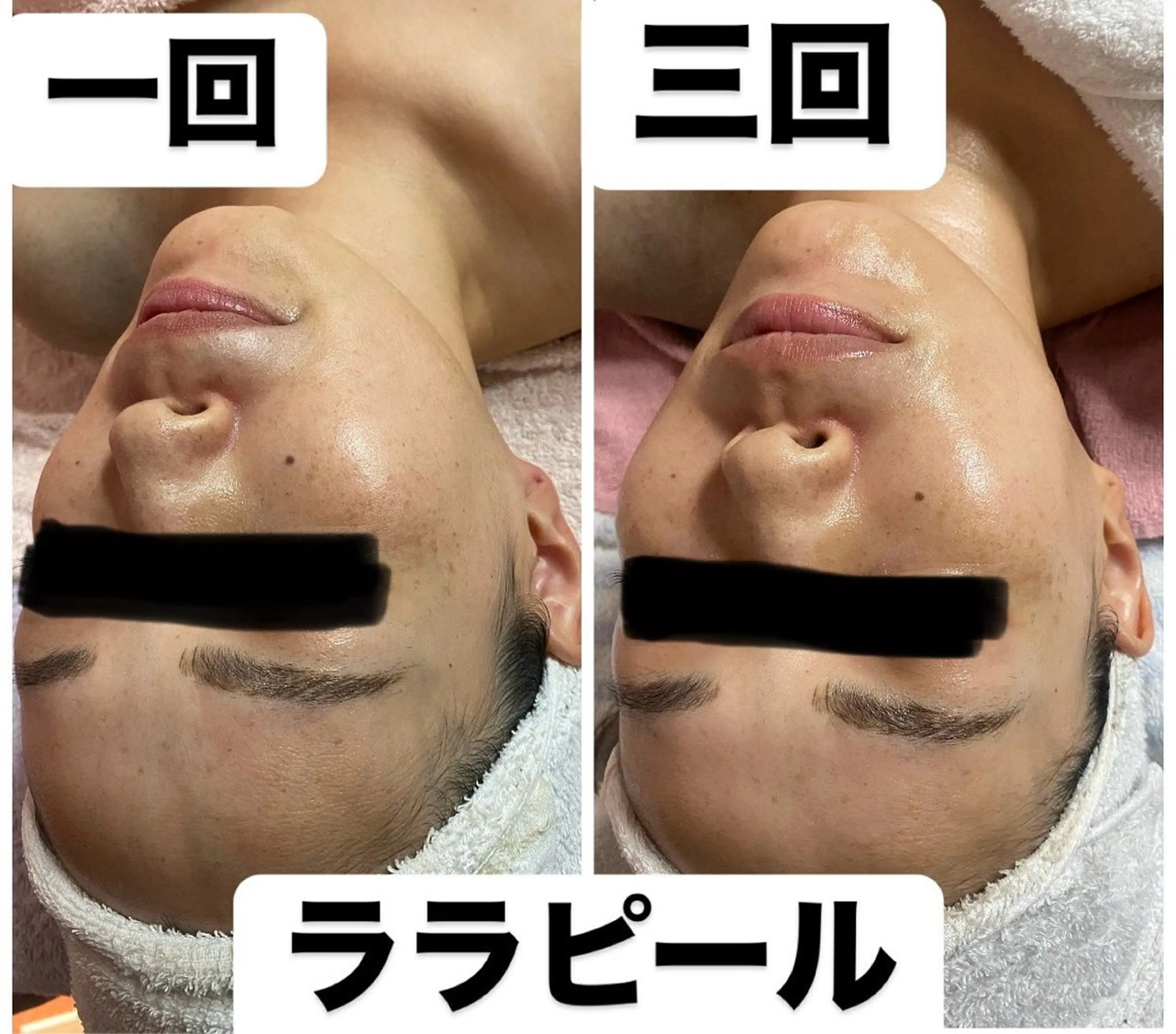 プラズマシャワー＋ララピール【顔、首】+デコルテリンパケアメヒト幹細胞パックプラズマ導入の写真
