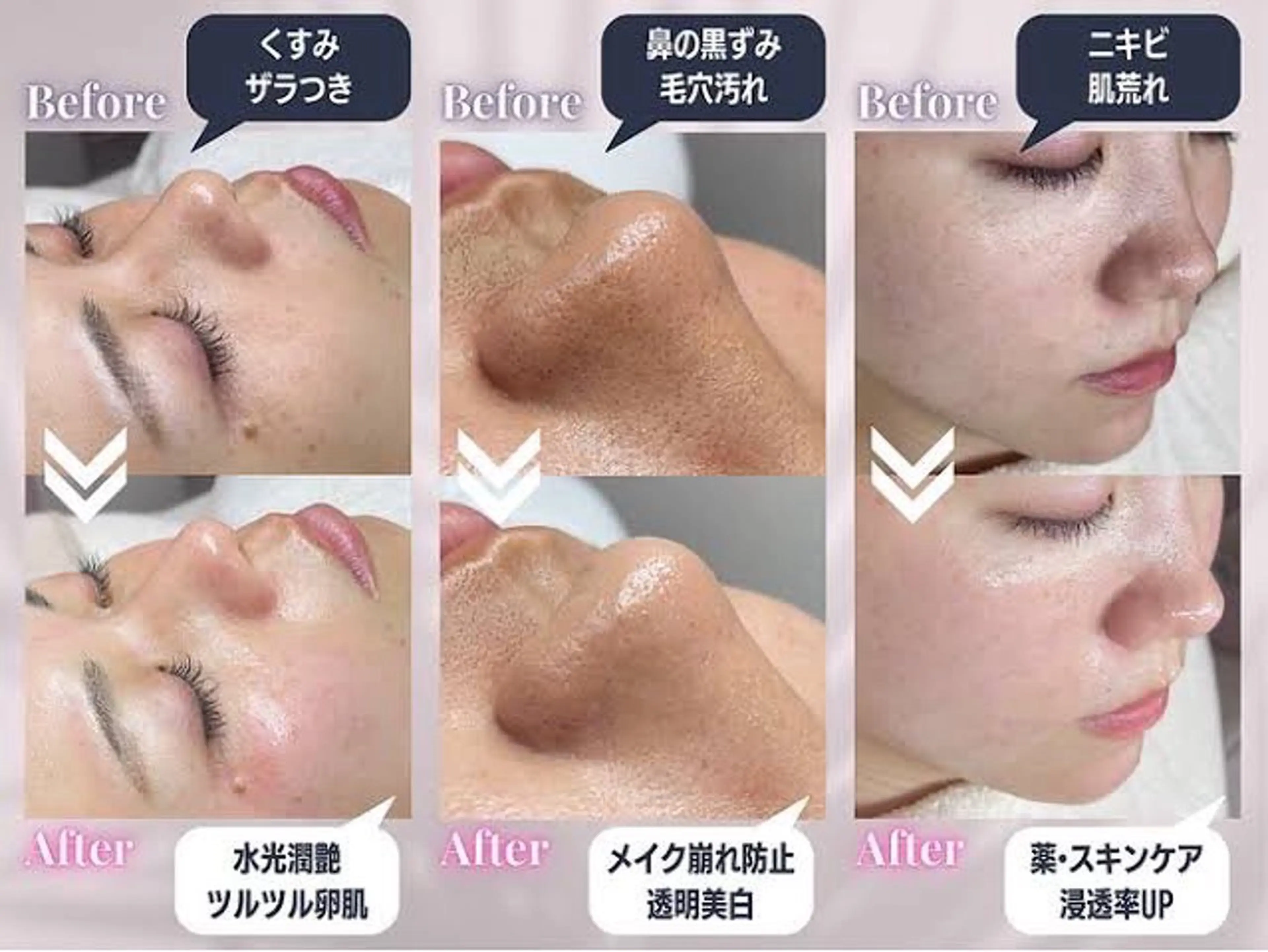 【ハイドラフェイシャル】毛穴の黒ずみや開きのお悩みを解消✨の写真