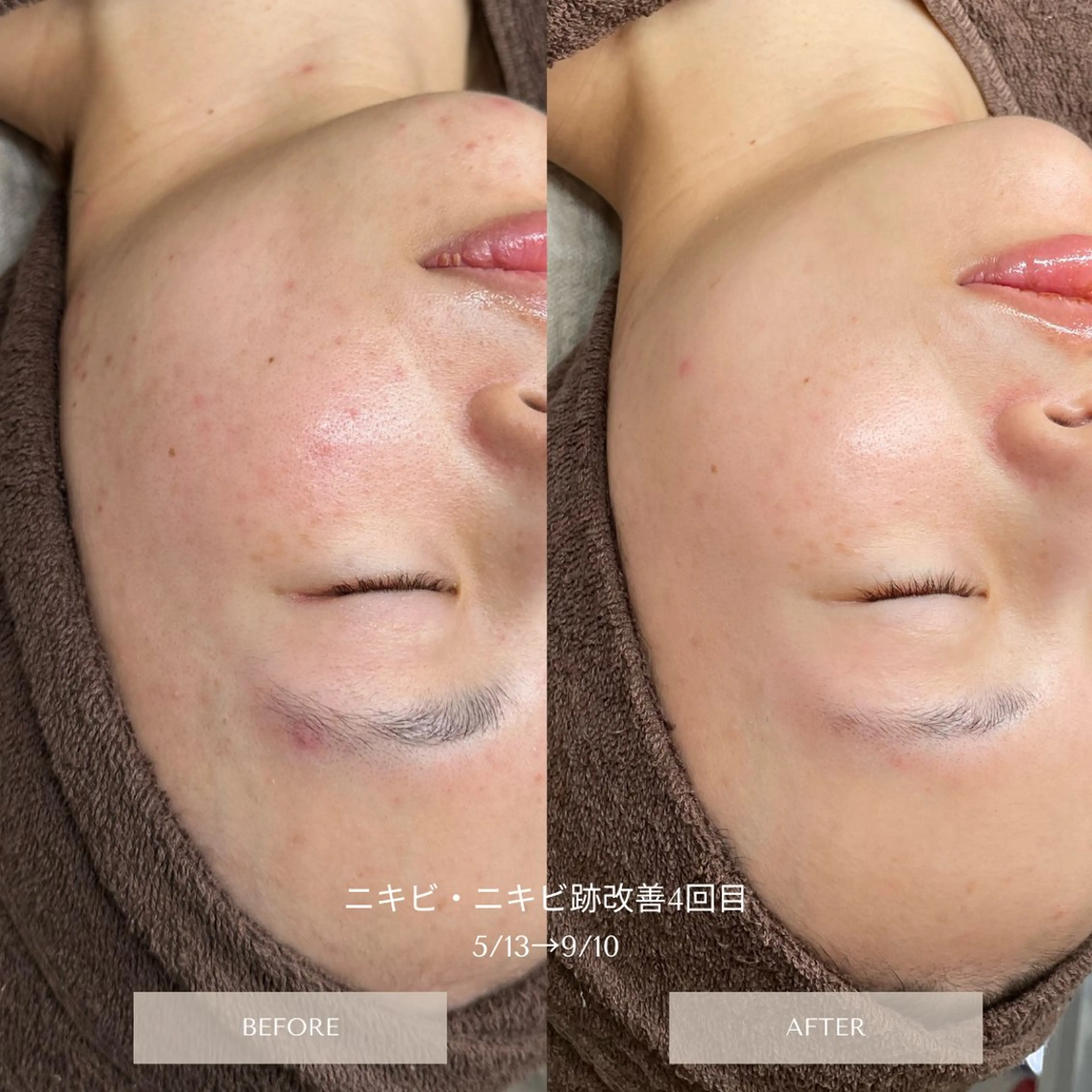 【韓国式】3ヶ月でお悩み改善！ハーブピーリングの写真
