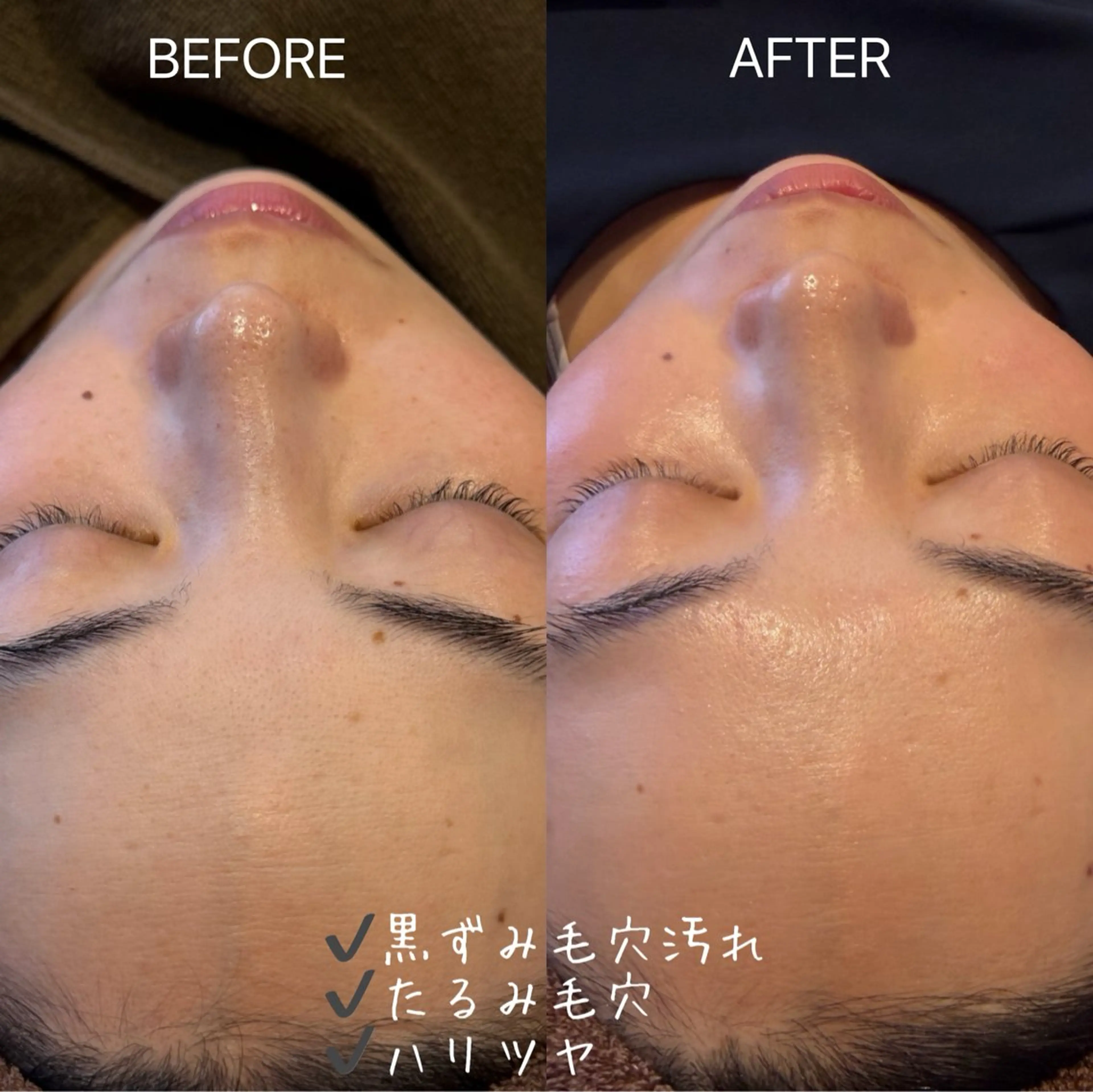 【12/16まで限定💝】肌診断+ミクロ毛穴スペシャルケアコース🪄の写真