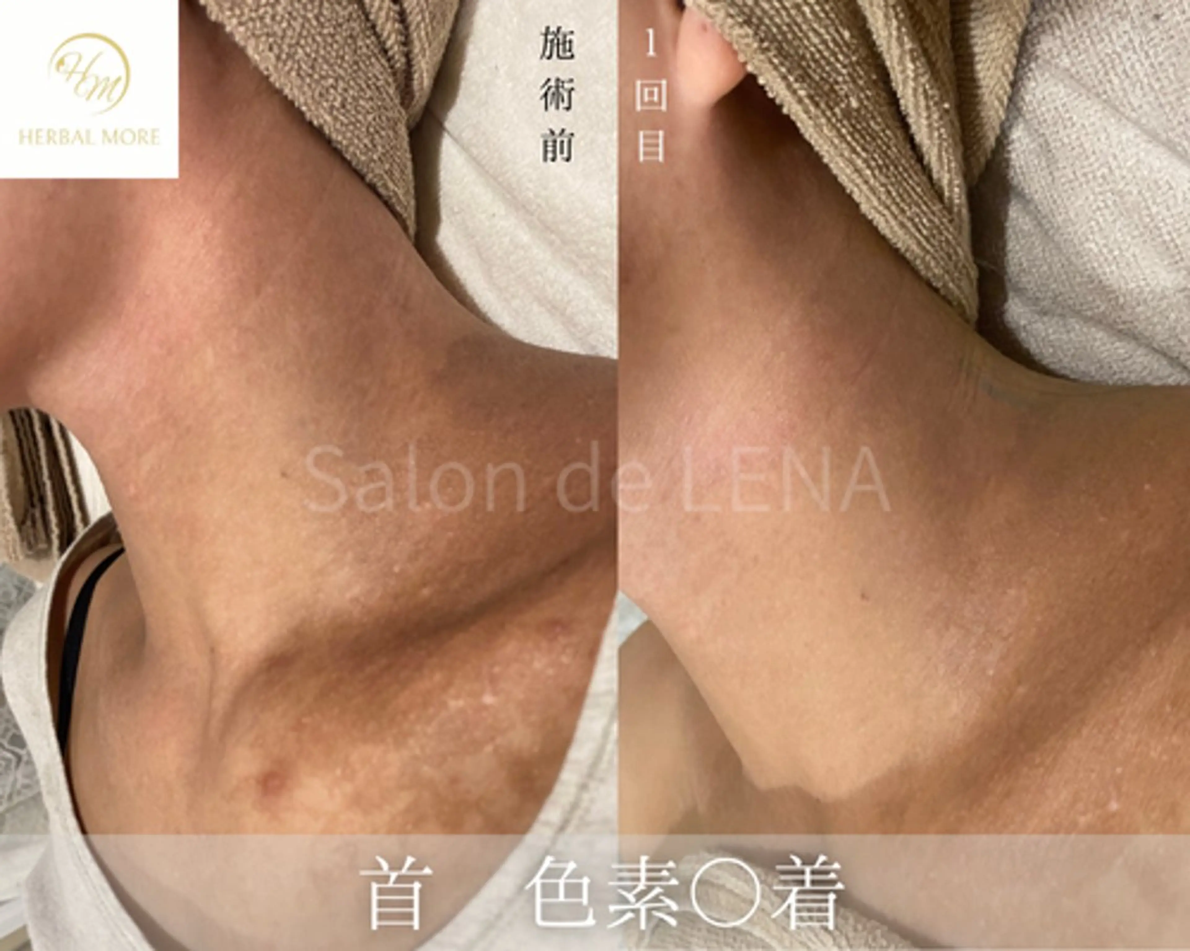 【首◆35歳​〜​59歳限定】剥離ありハーブピーリングの写真