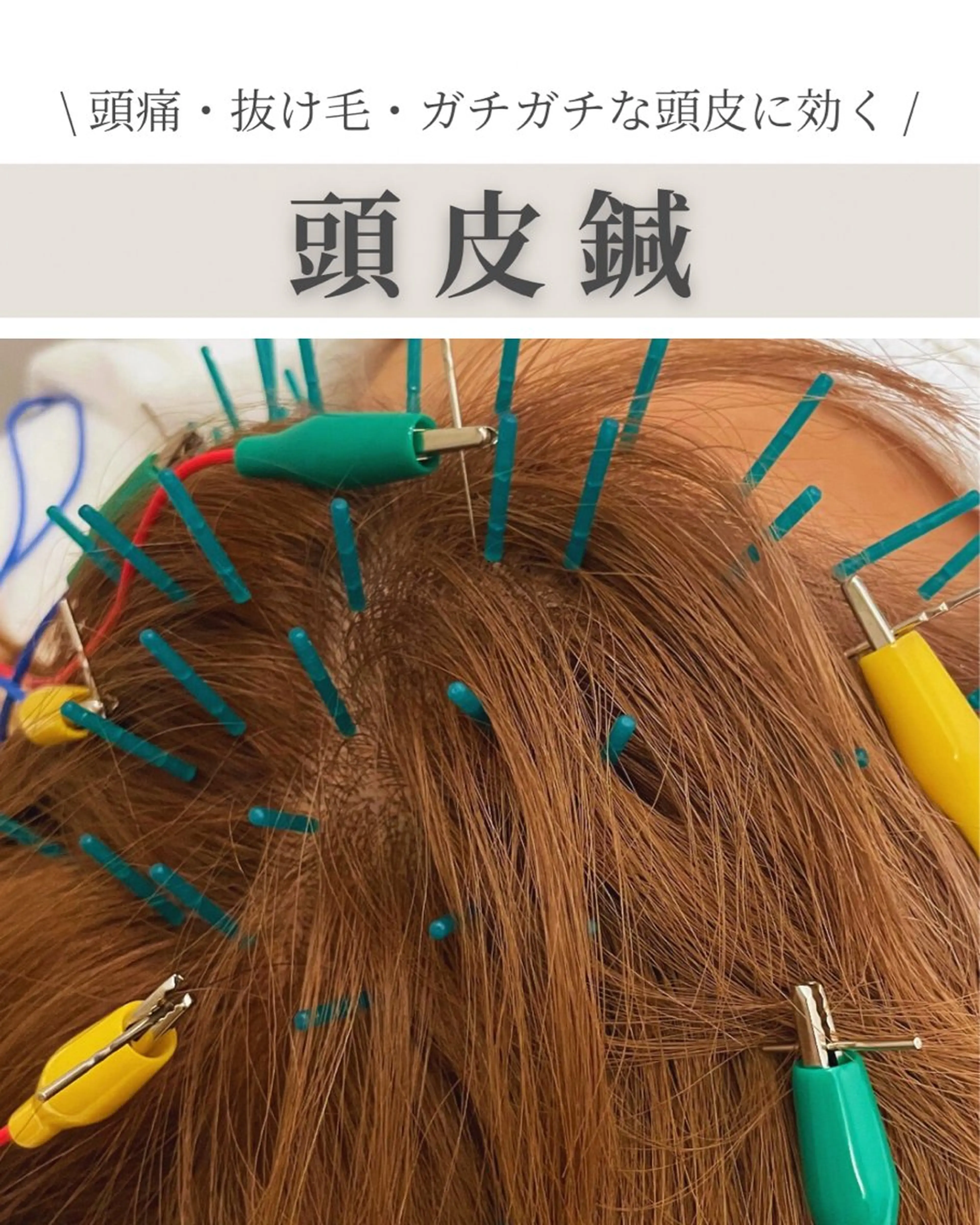 【ご新規様限定】  \人気No.1 /  頭皮鍼➕ヘッドマッサージの写真