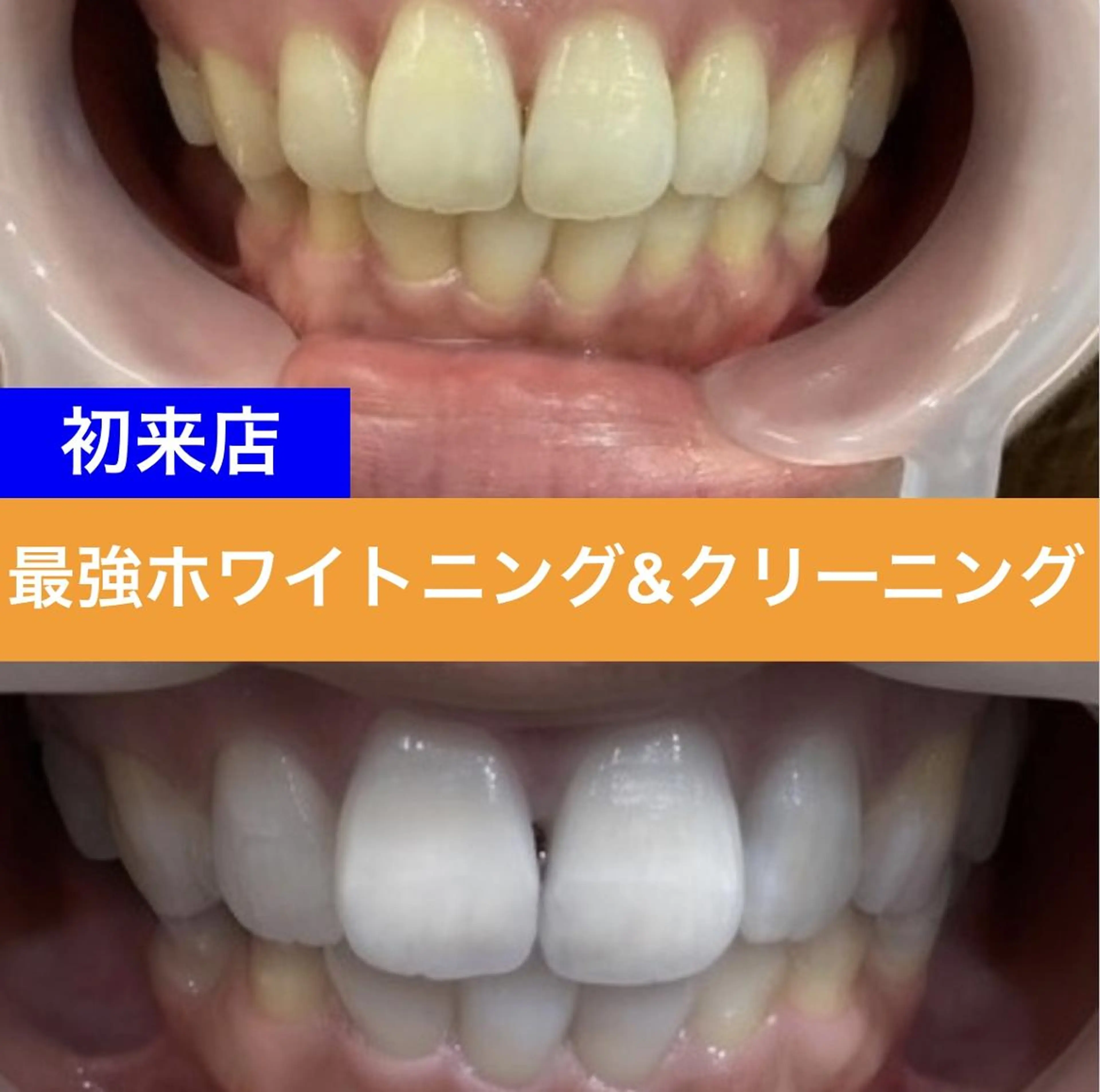 【最強ホワイトニング】クリーニング&効果2倍ジェル LED照射15分×2回　¥6600の写真