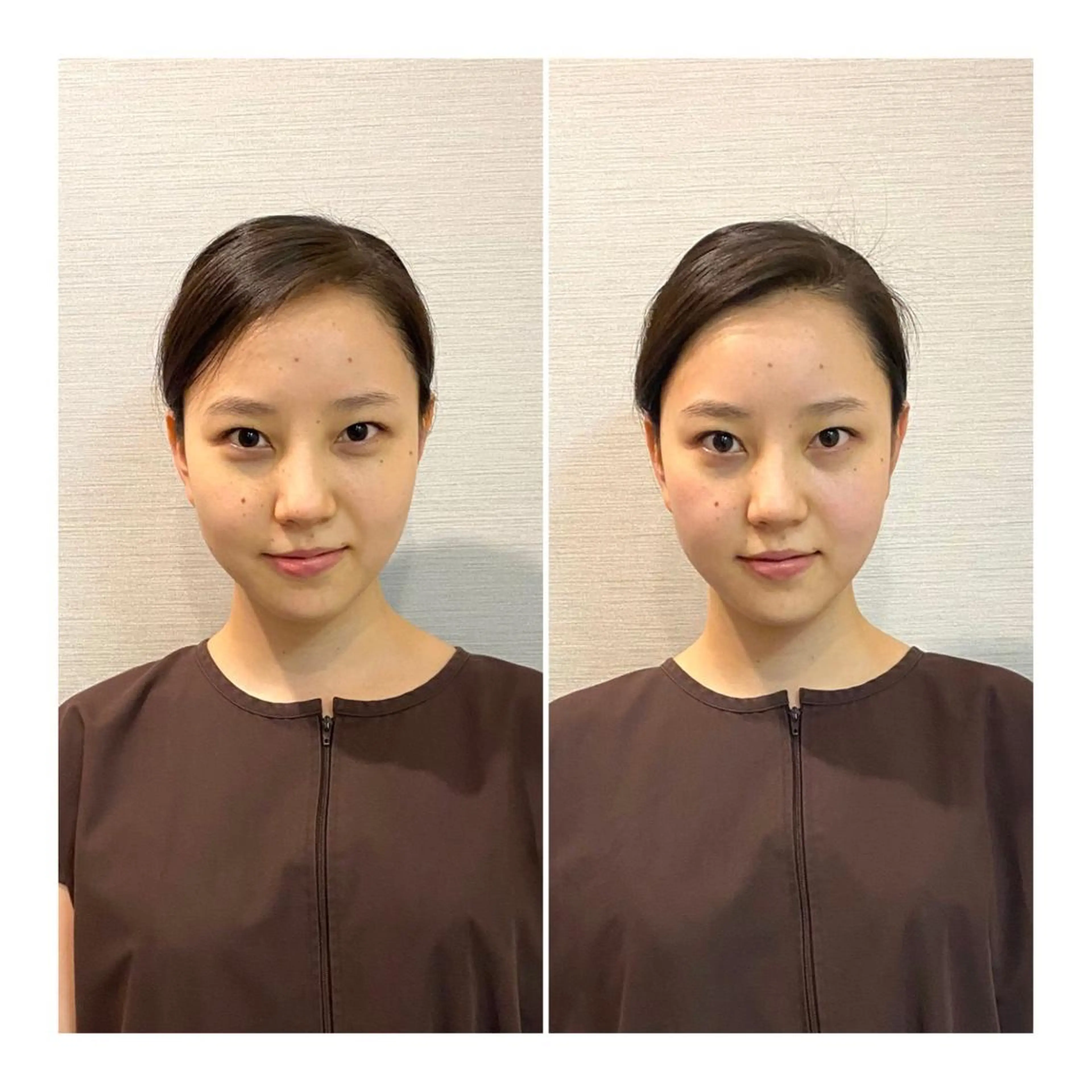 その他 即小顔♥️美容鍼× ハーブピーリングのその他イメージ