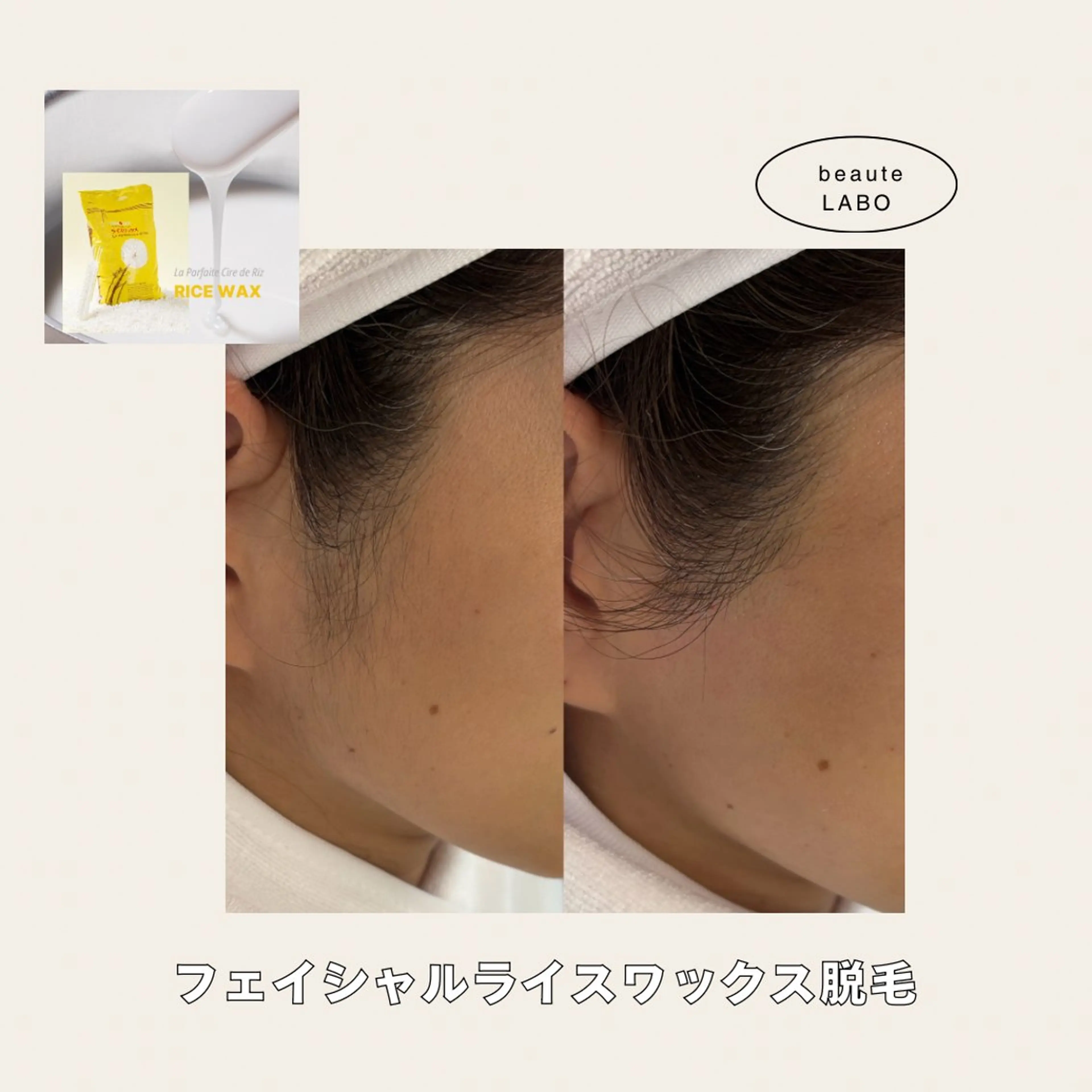 フェイシャルライスワックス脱毛【waxxxx使用】の写真