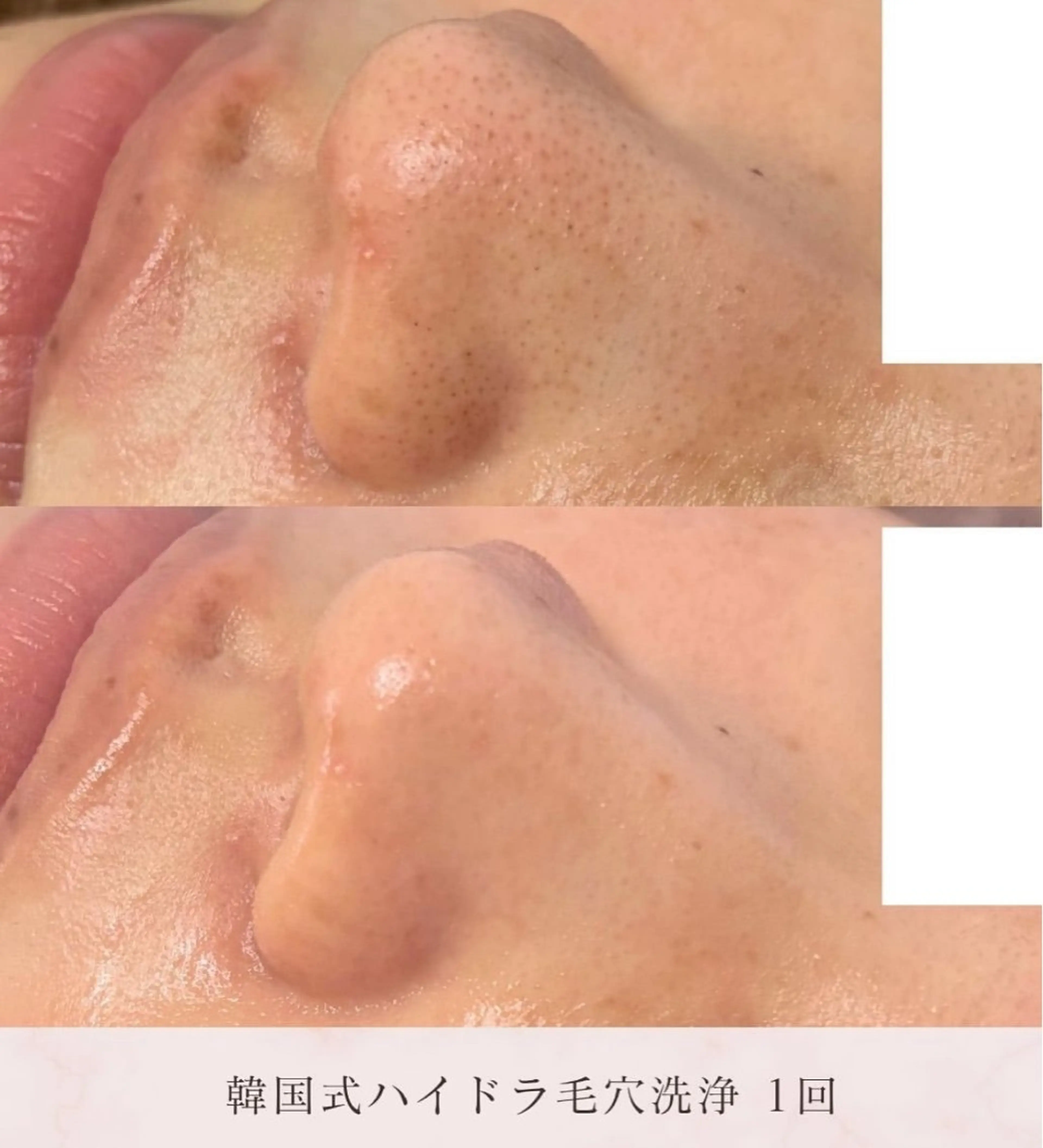 毛穴レス美肌へ🌿 看護師Abe🌼のエステ・リラクイメージ