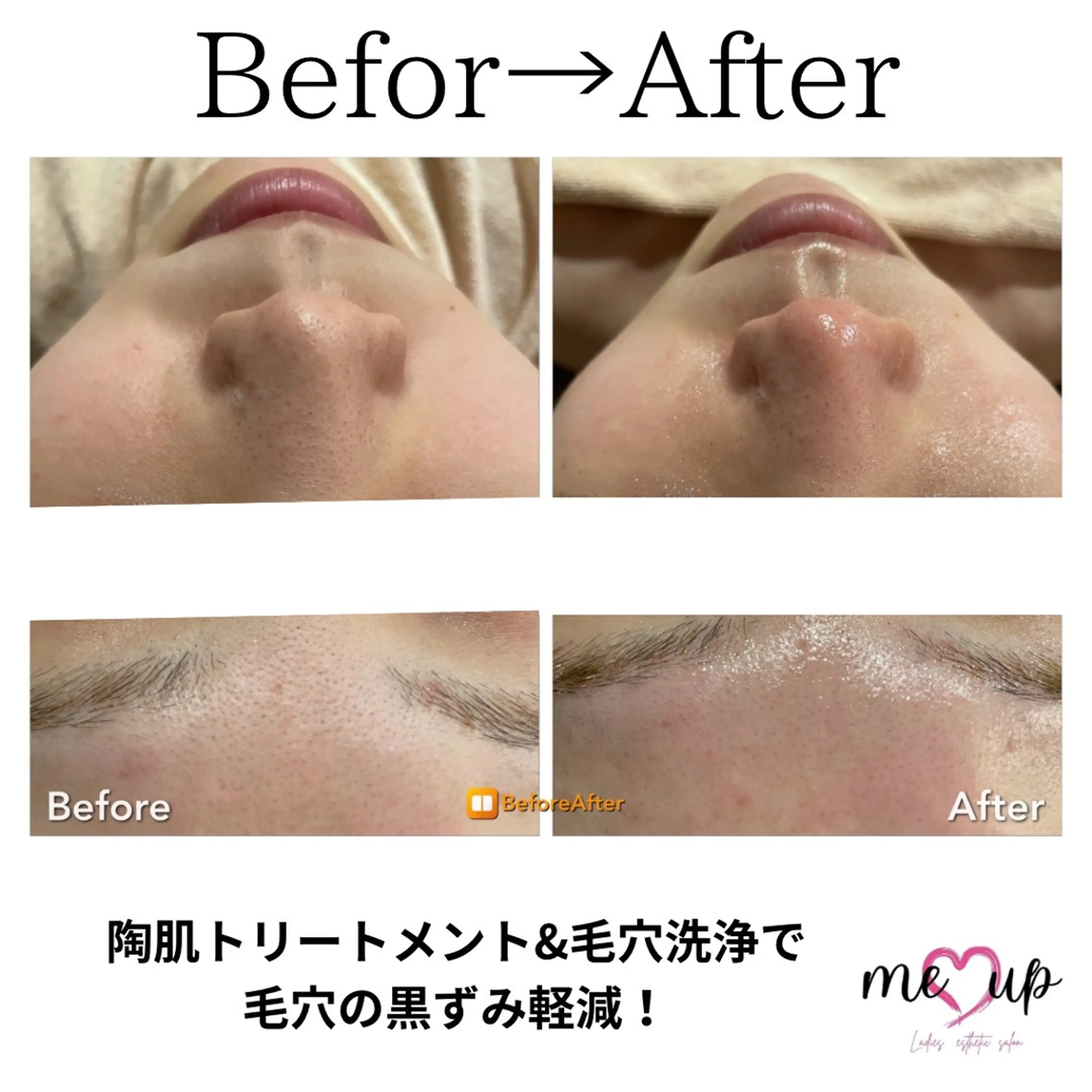 エステ Meupニキビ専門店 背中/ハーブ/ララのその他イメージ