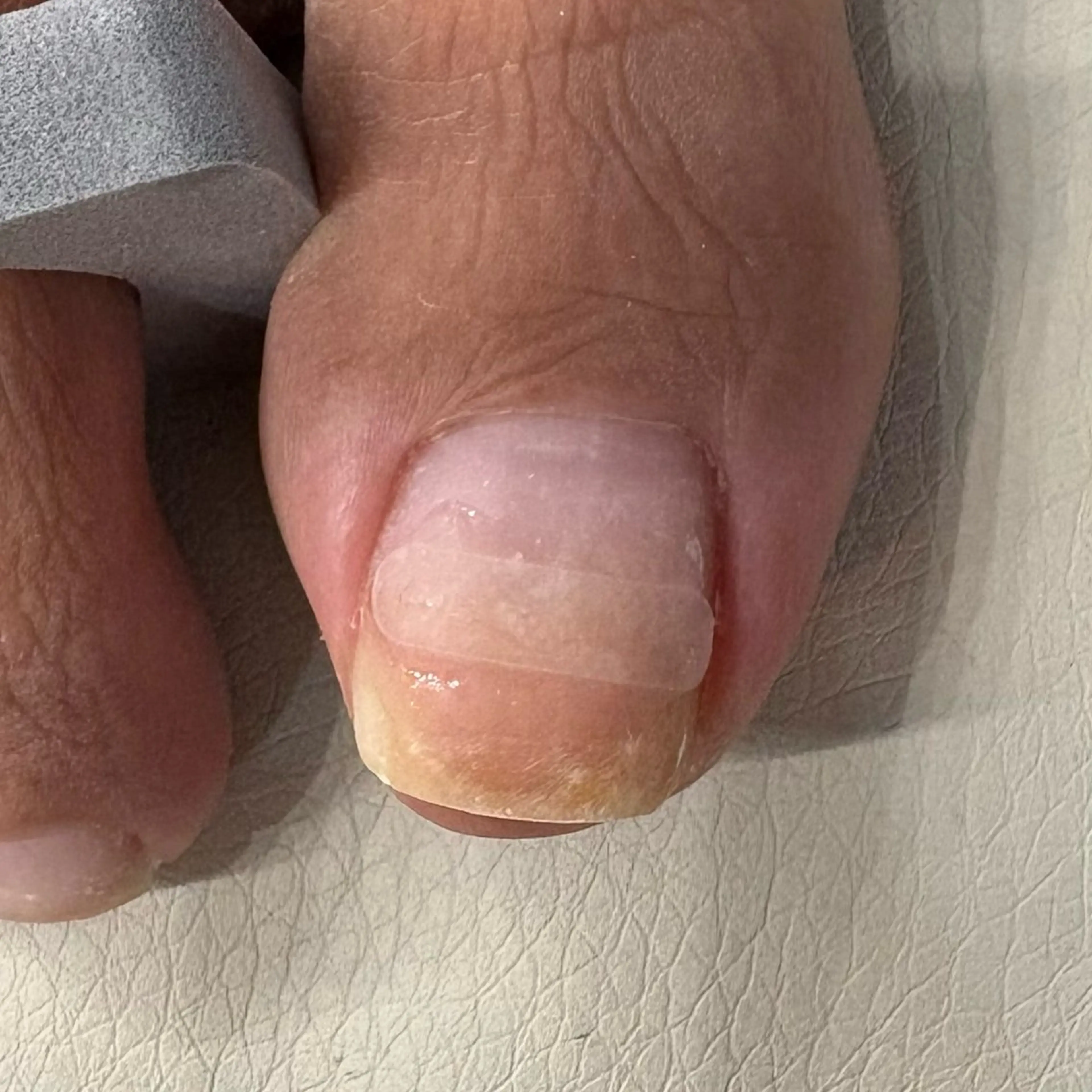 巻き爪フットワンカラーの写真