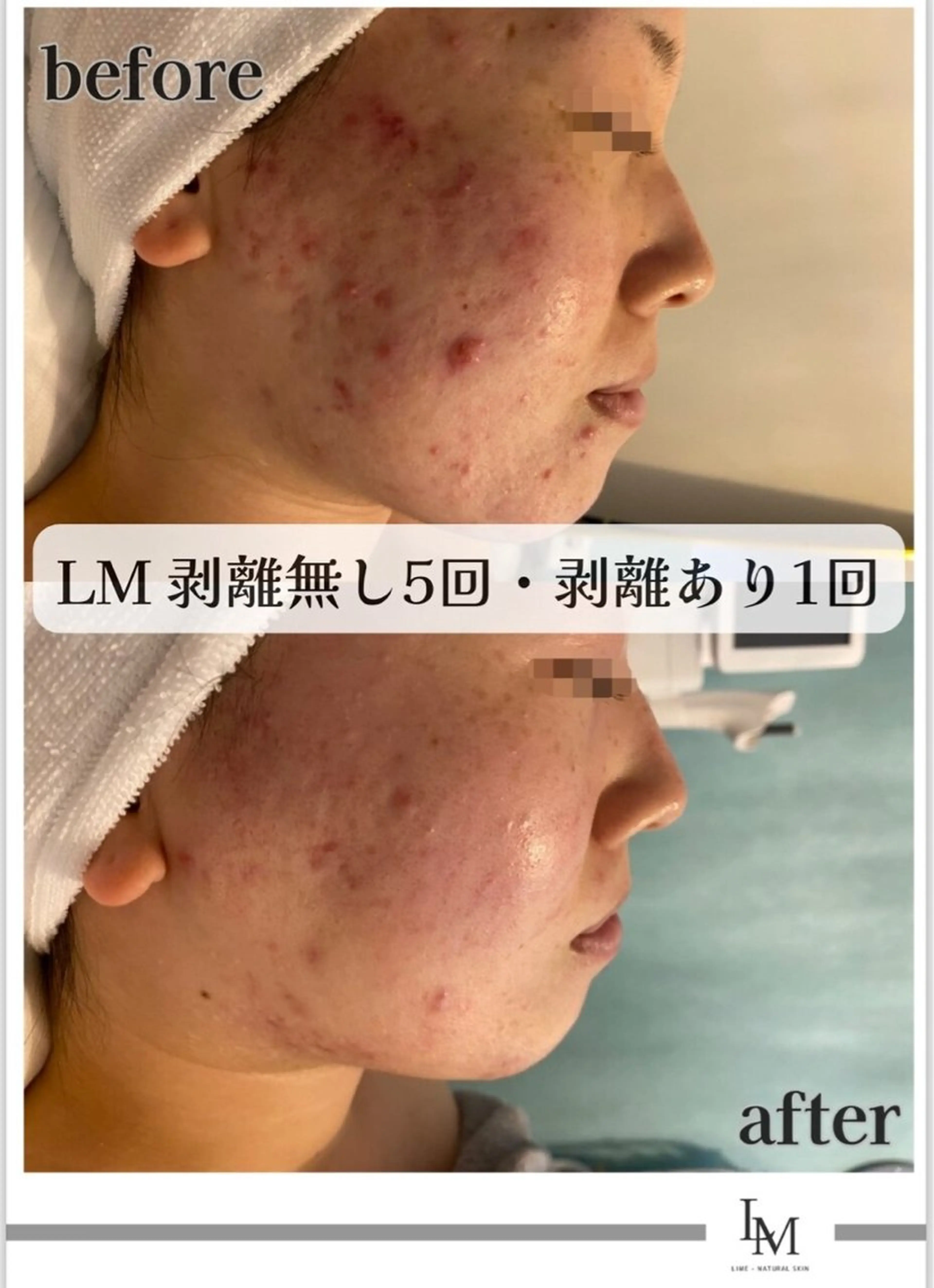 ハーブピーリング LIME池袋東口のエステ・リラクイメージ