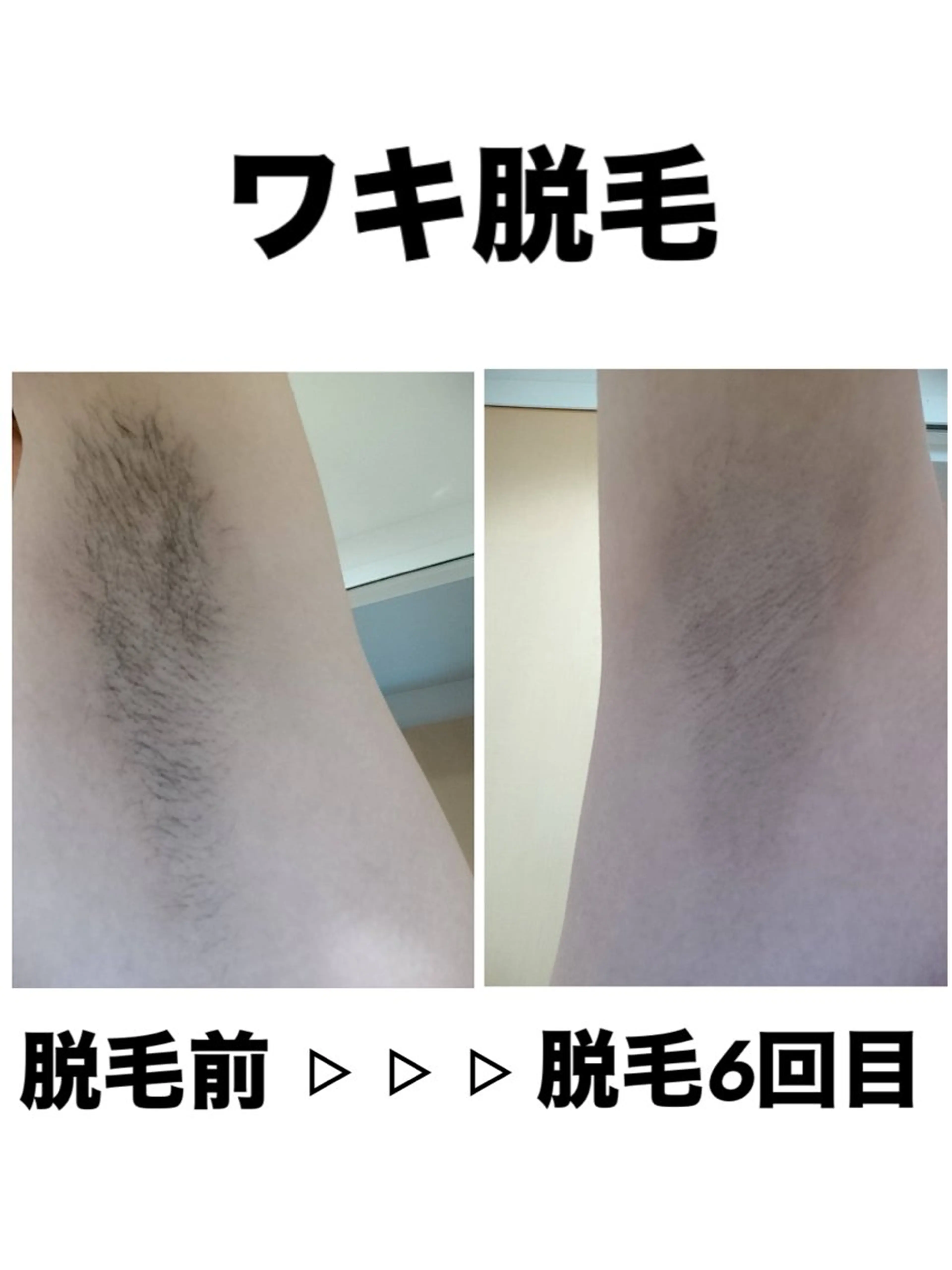 脱毛 脱毛・眉毛・フェイス サロンN久留米店のその他イメージ