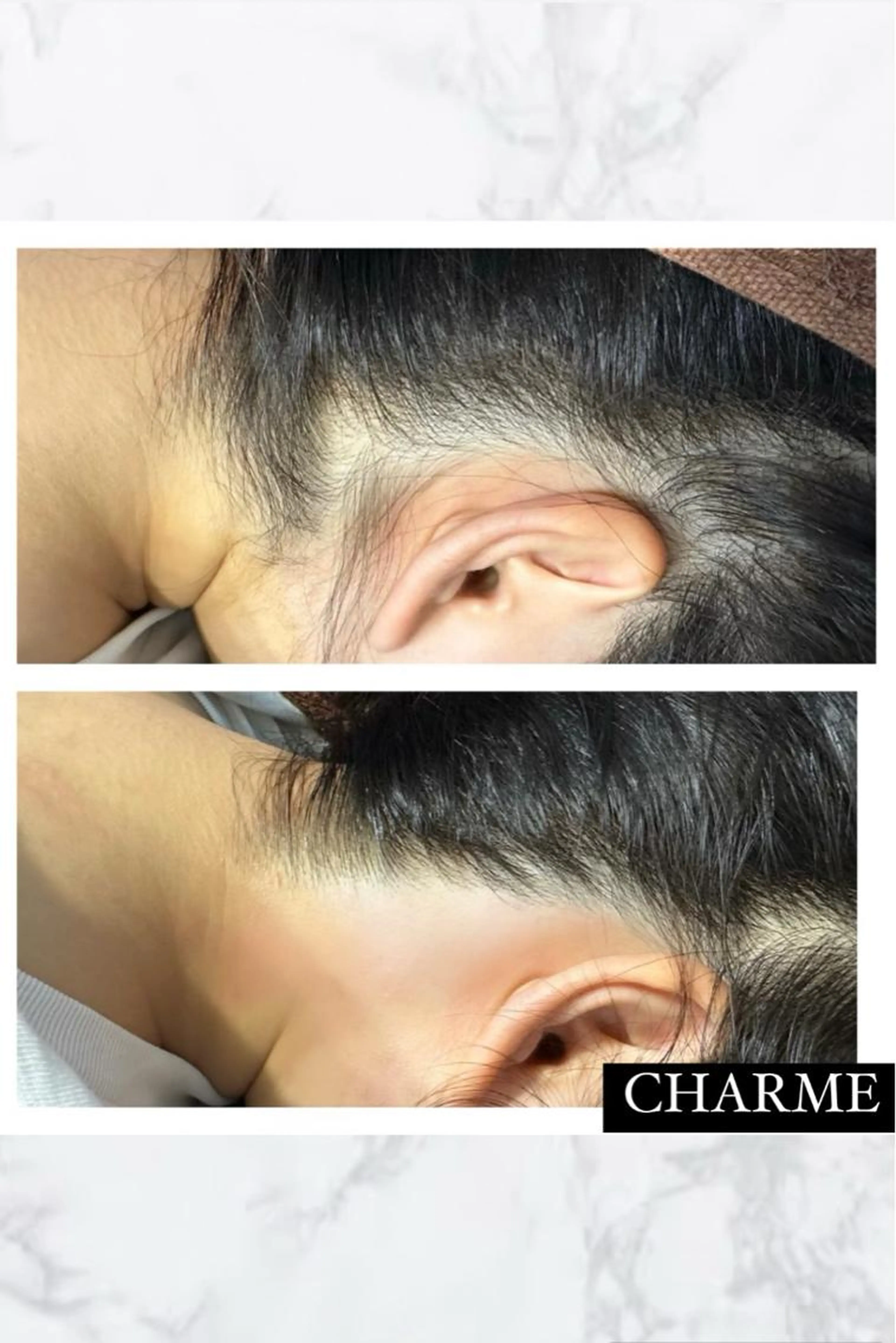 うなじダブル脱毛【ワックス✖️光】の写真