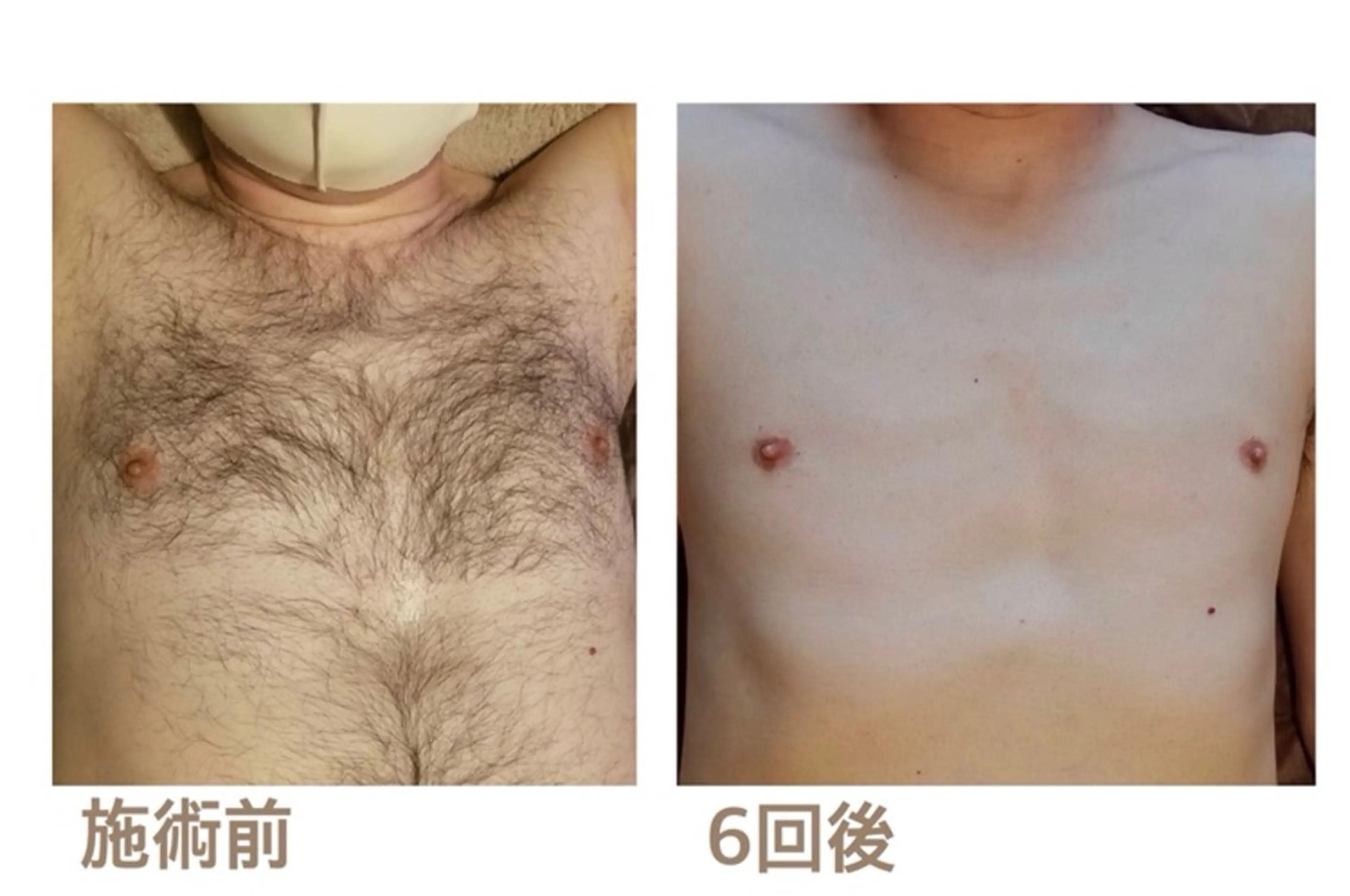清潔感爆上がり✨Men's全身脱毛(ＶＩＯなし)✨の写真