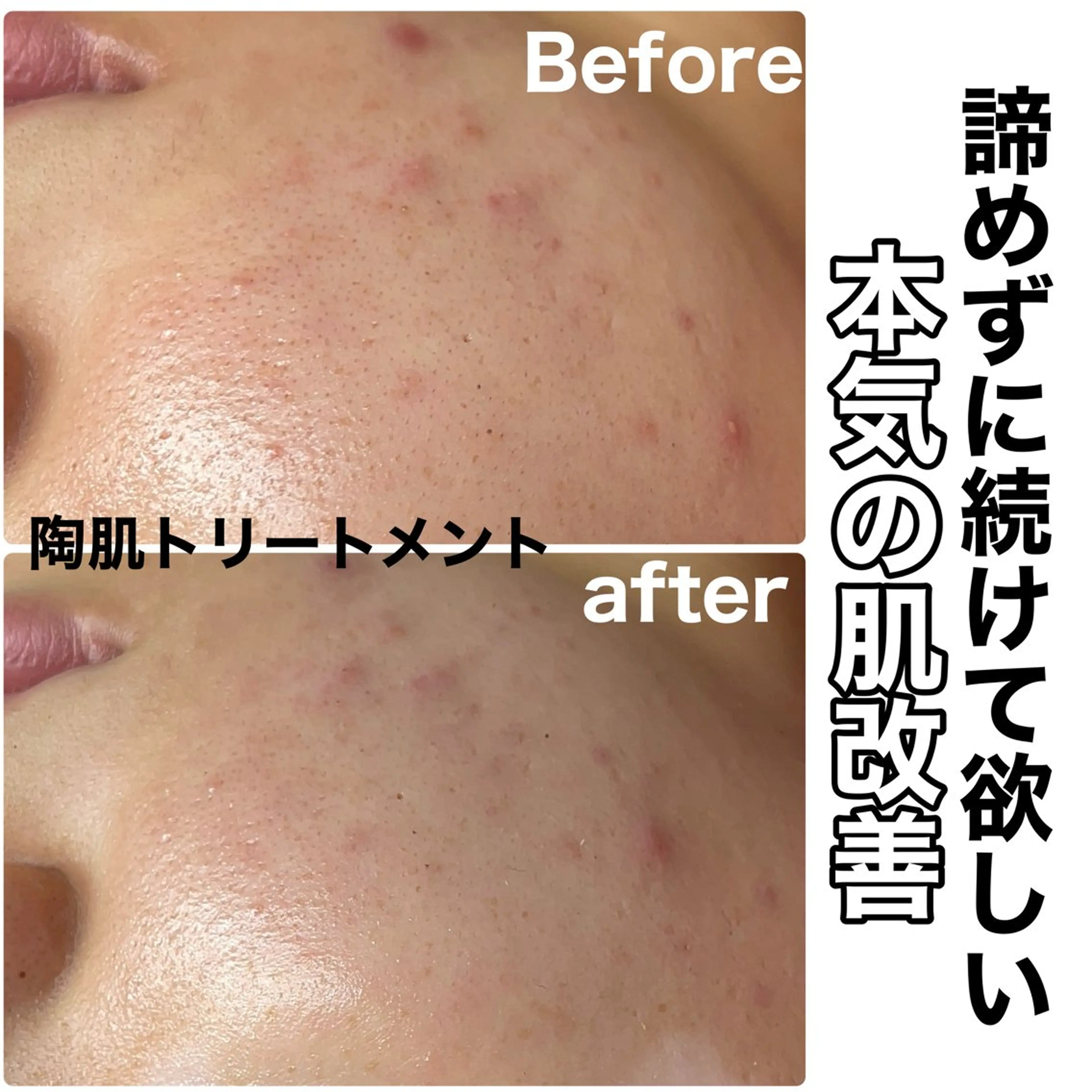 エステ Chalon所属・REVI取扱・肌悩み 改善　Chalonのエステ・リラクイメージ