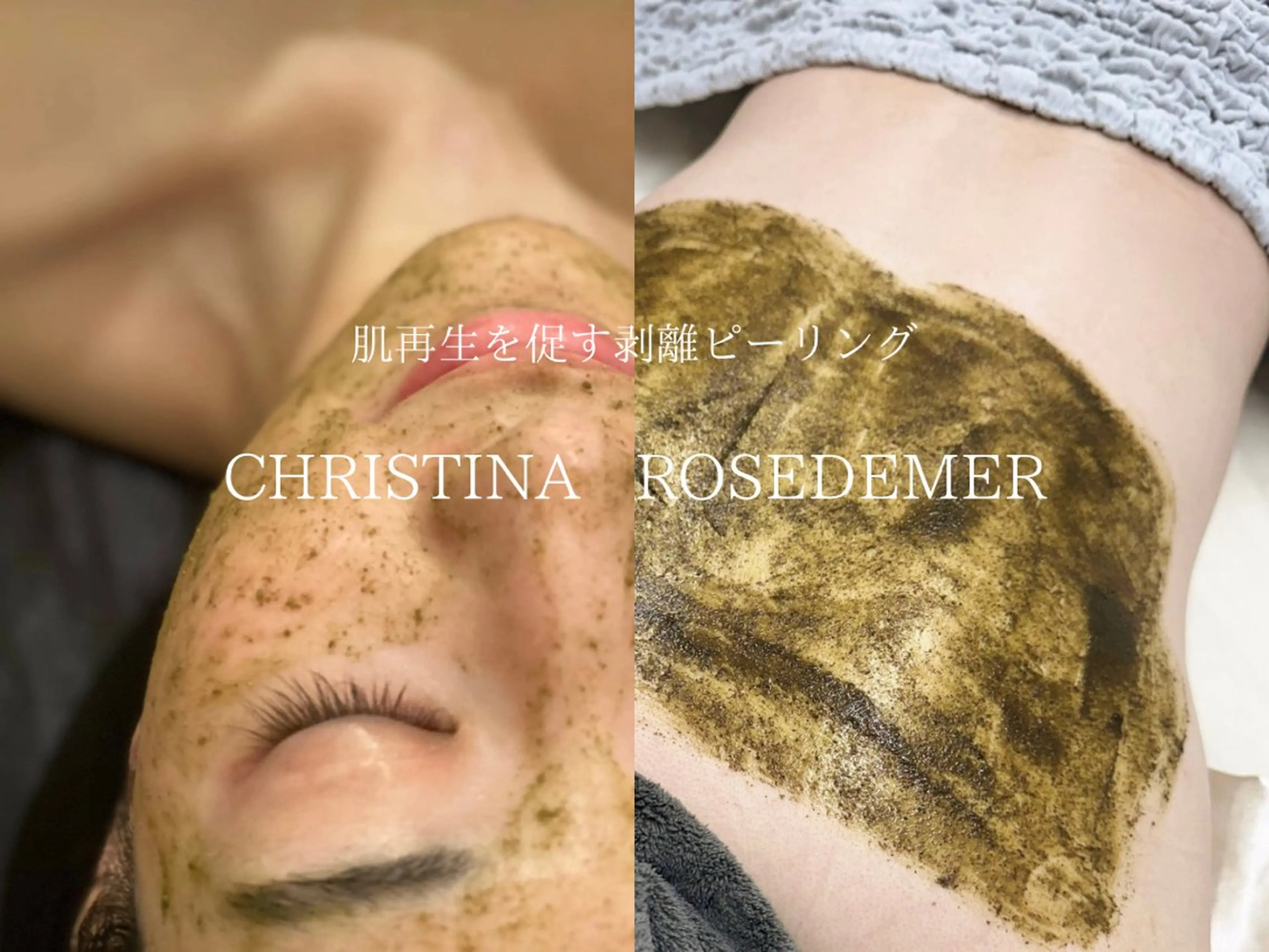 【10名様モニター限定】剥離ありハーブピーリング|ローズドメーラ|クリスティーナ|顔or背中の写真