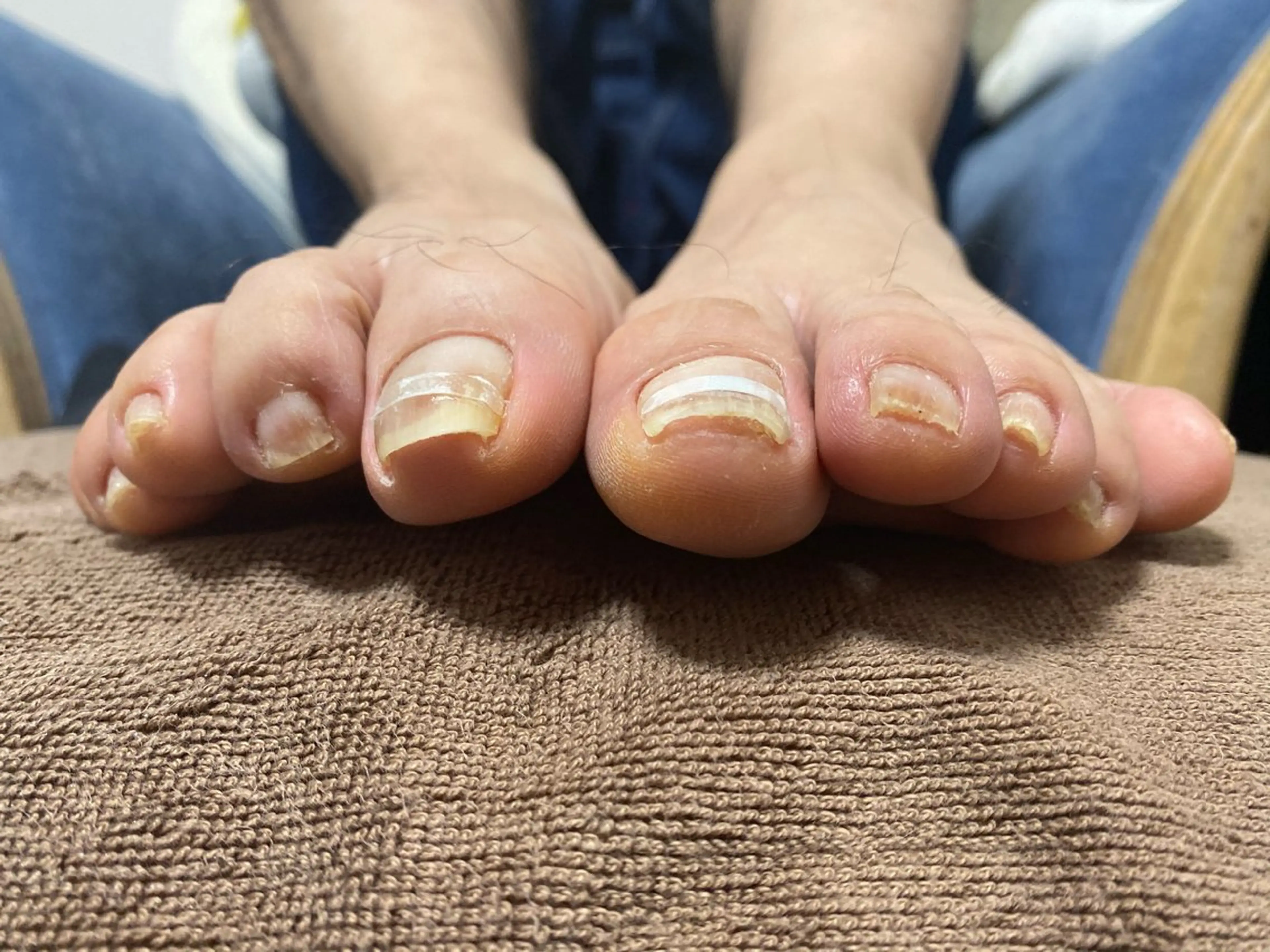 フットケアネイル 巻爪矯正 1趾補修【美爪育成】の写真
