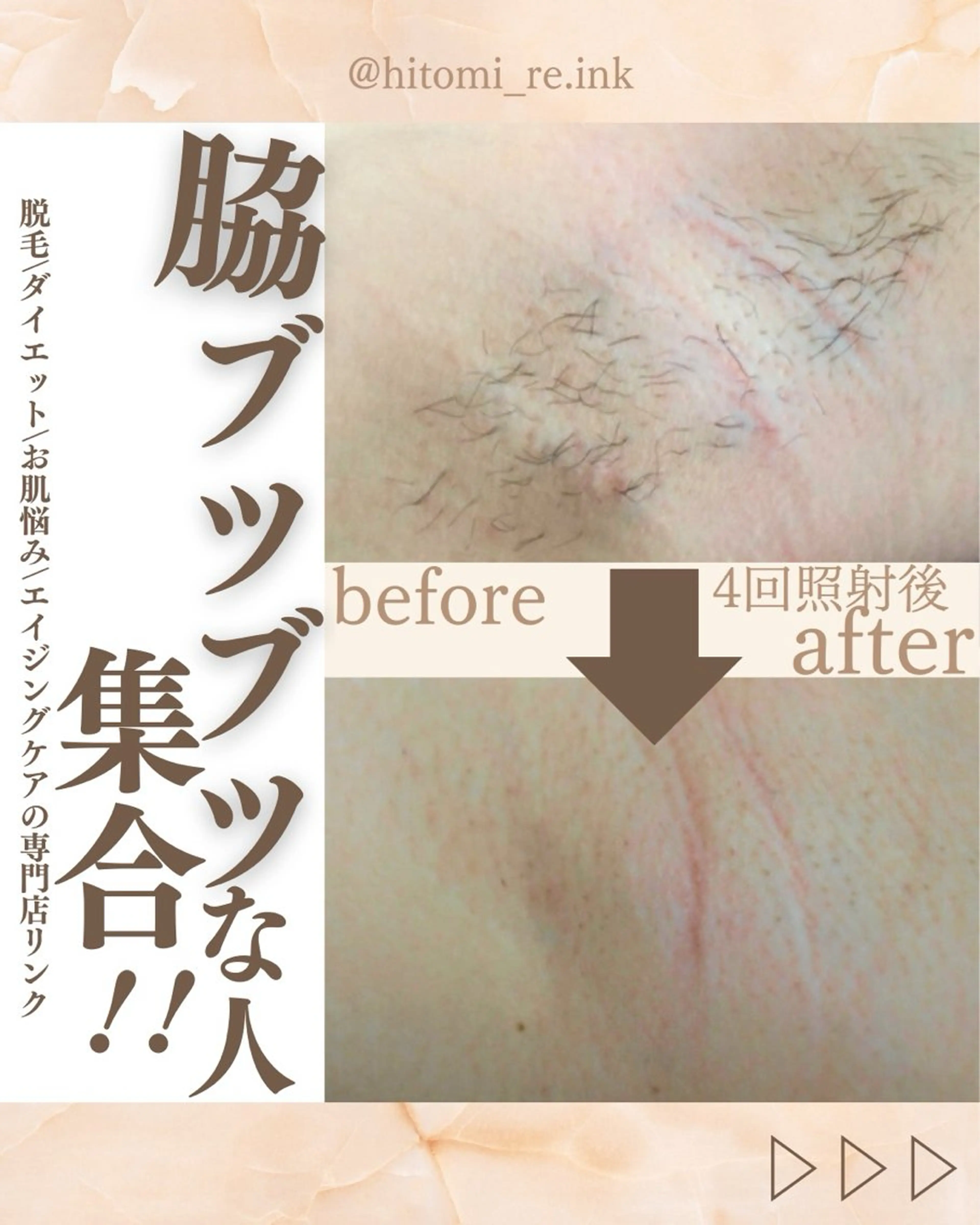 脱毛人気部位No. 1脇脱毛の写真