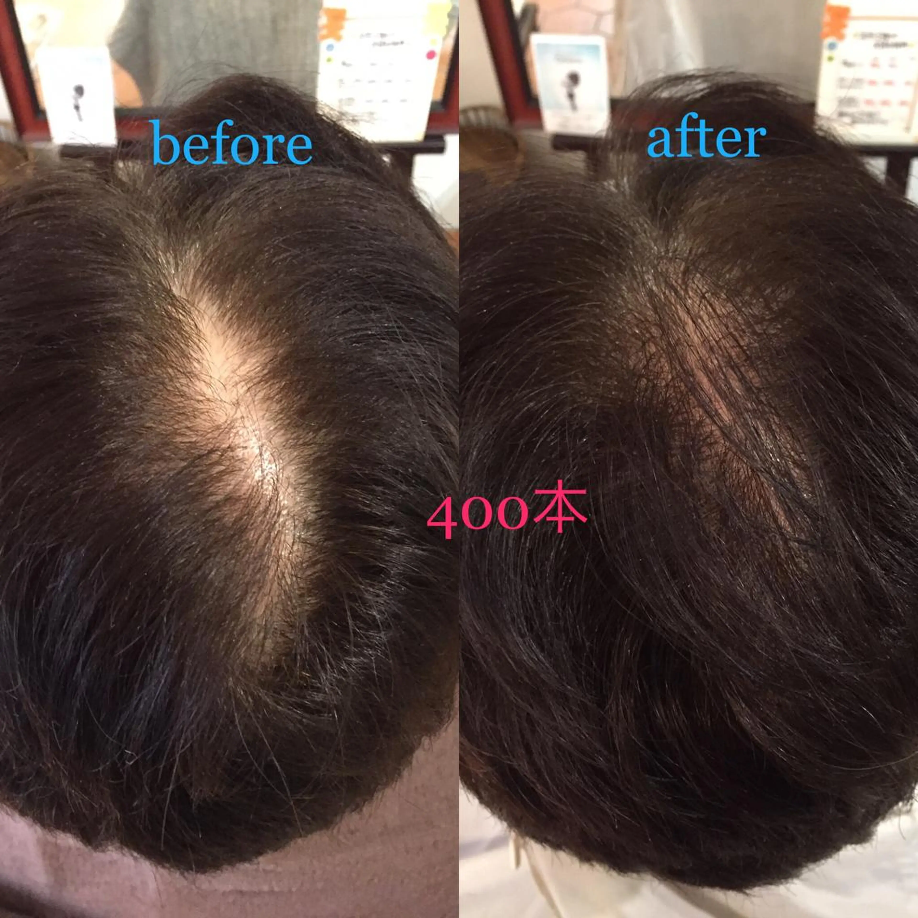 パーマをあてずにふんわりボリュームが出る！薄くなった分け目が消える増毛エクステ ☆ヘアアディクト300本の写真