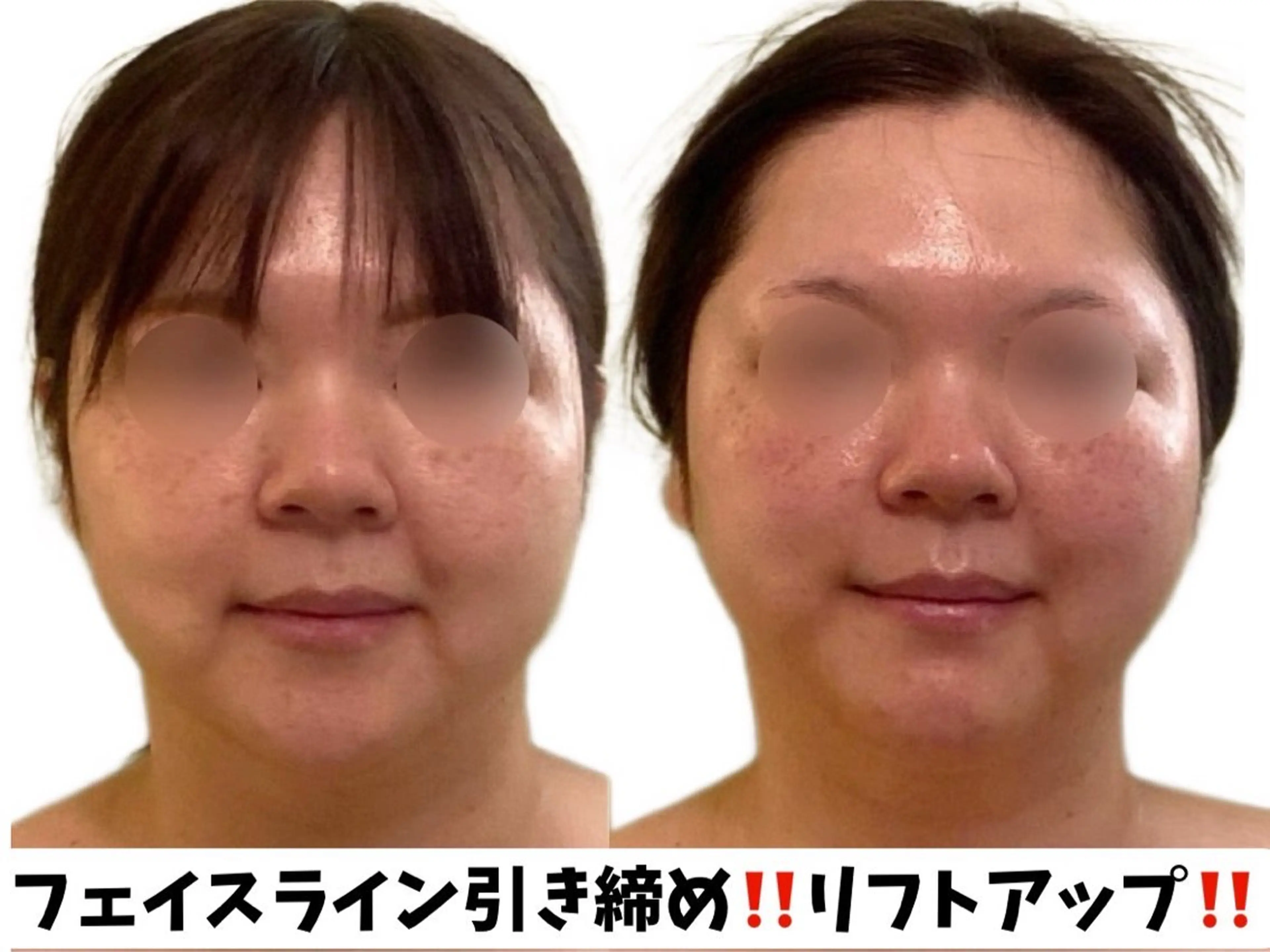小顔ハイパーナイフ×コルギマッサージの写真