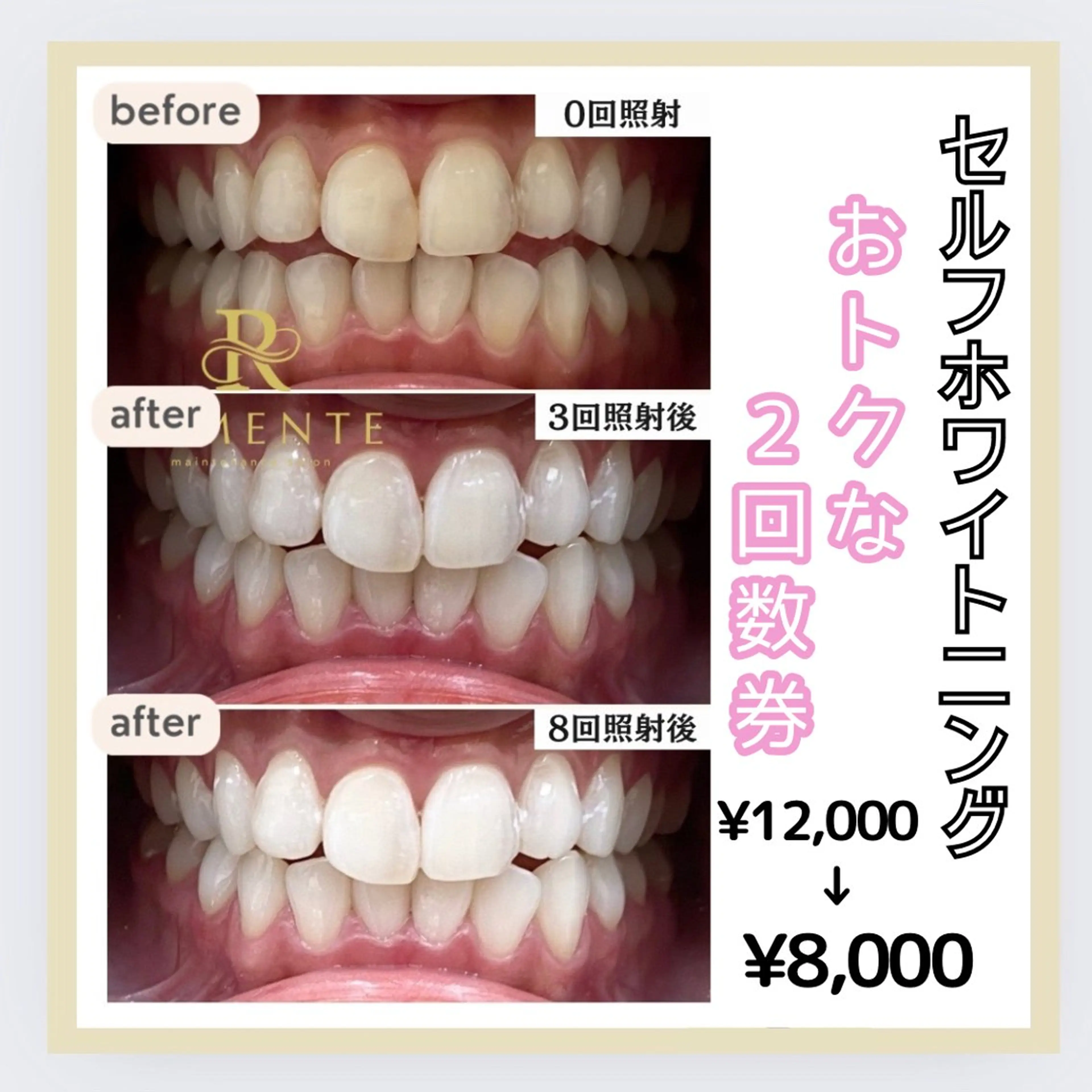 セルフホワイトニング【2回数券】※注意事項を必ずお読みください※の写真