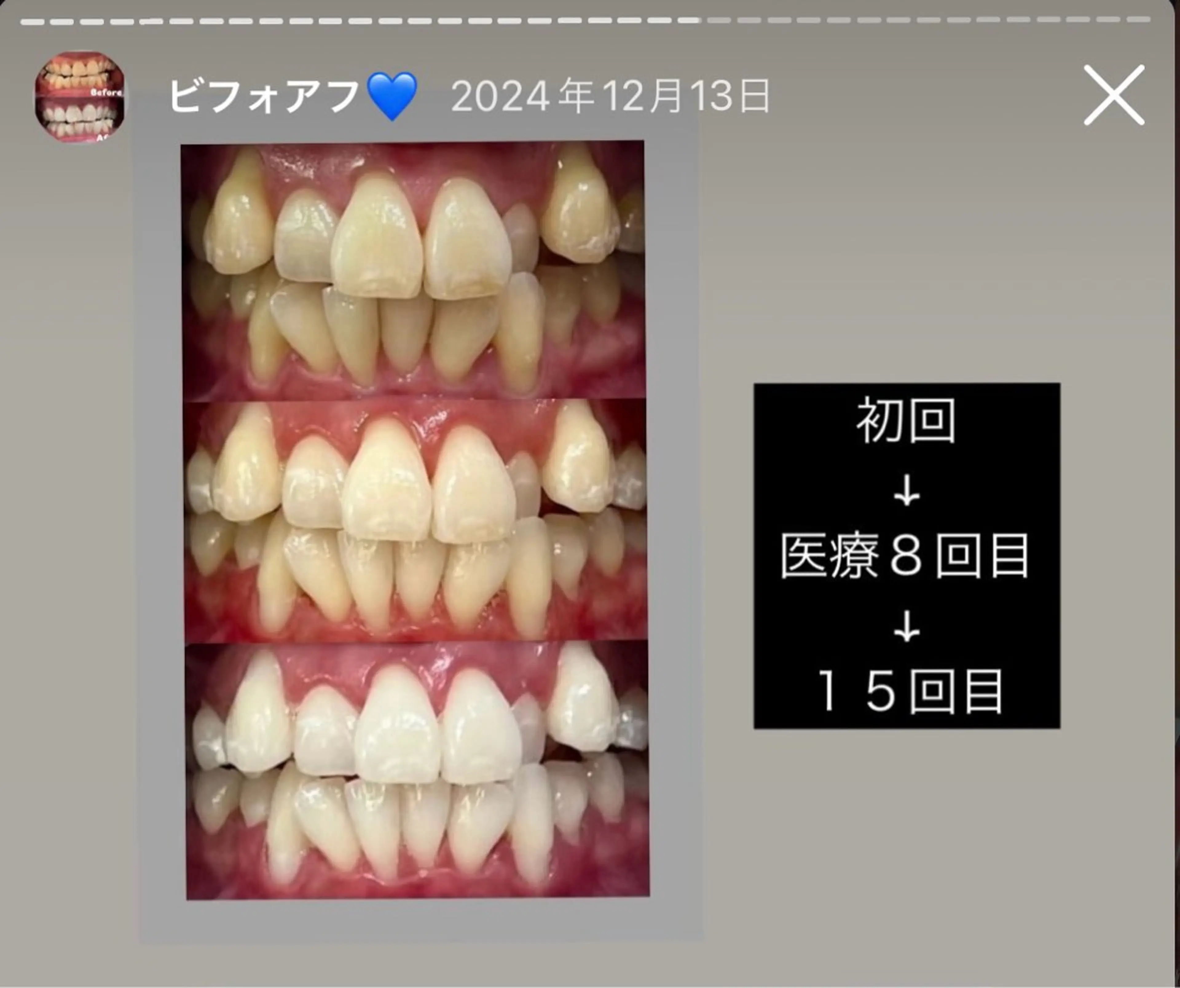 Kaula所属・Kaula セルフホワイトニングのその他イメージ