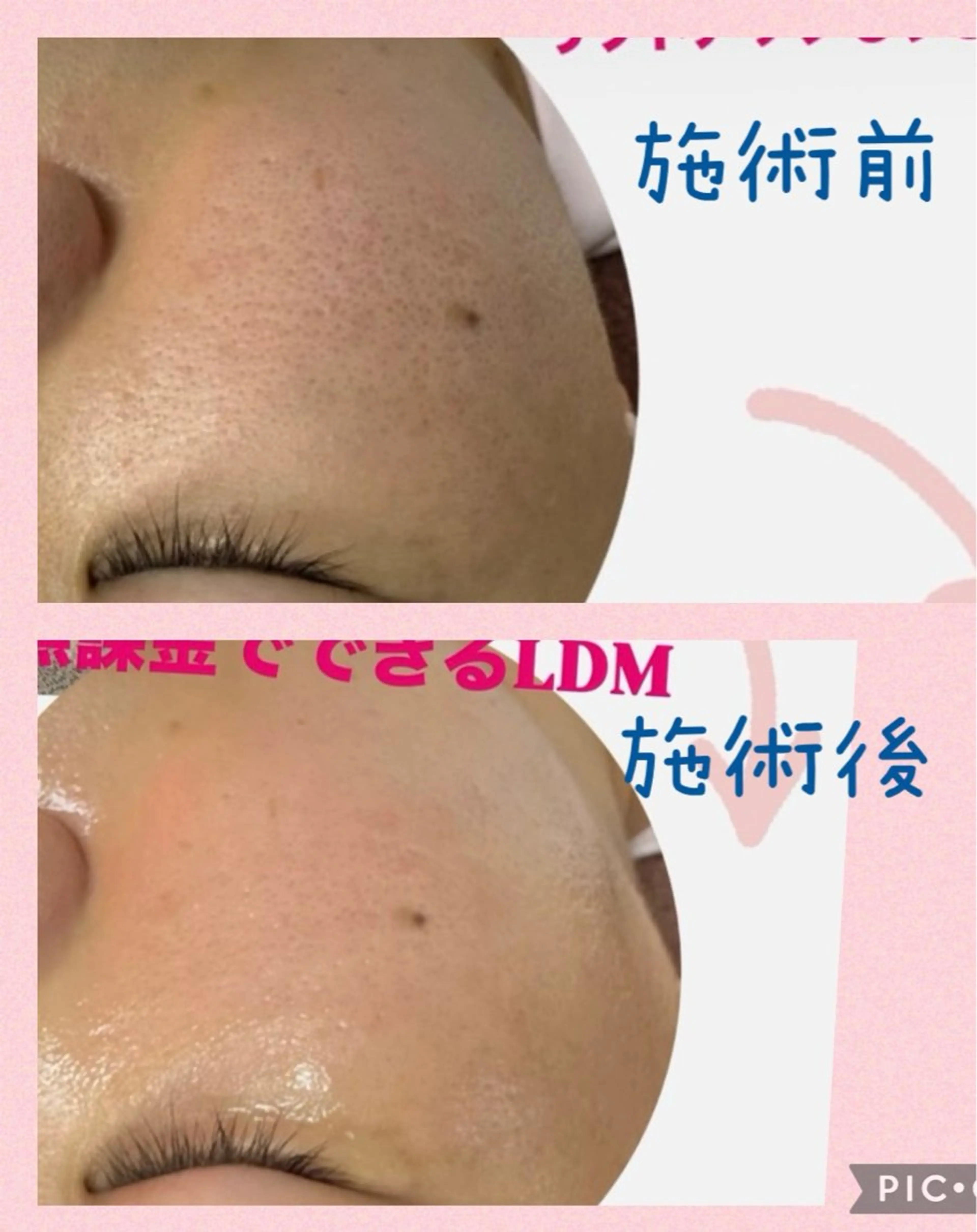 LDMで、肌トラブル改善の写真