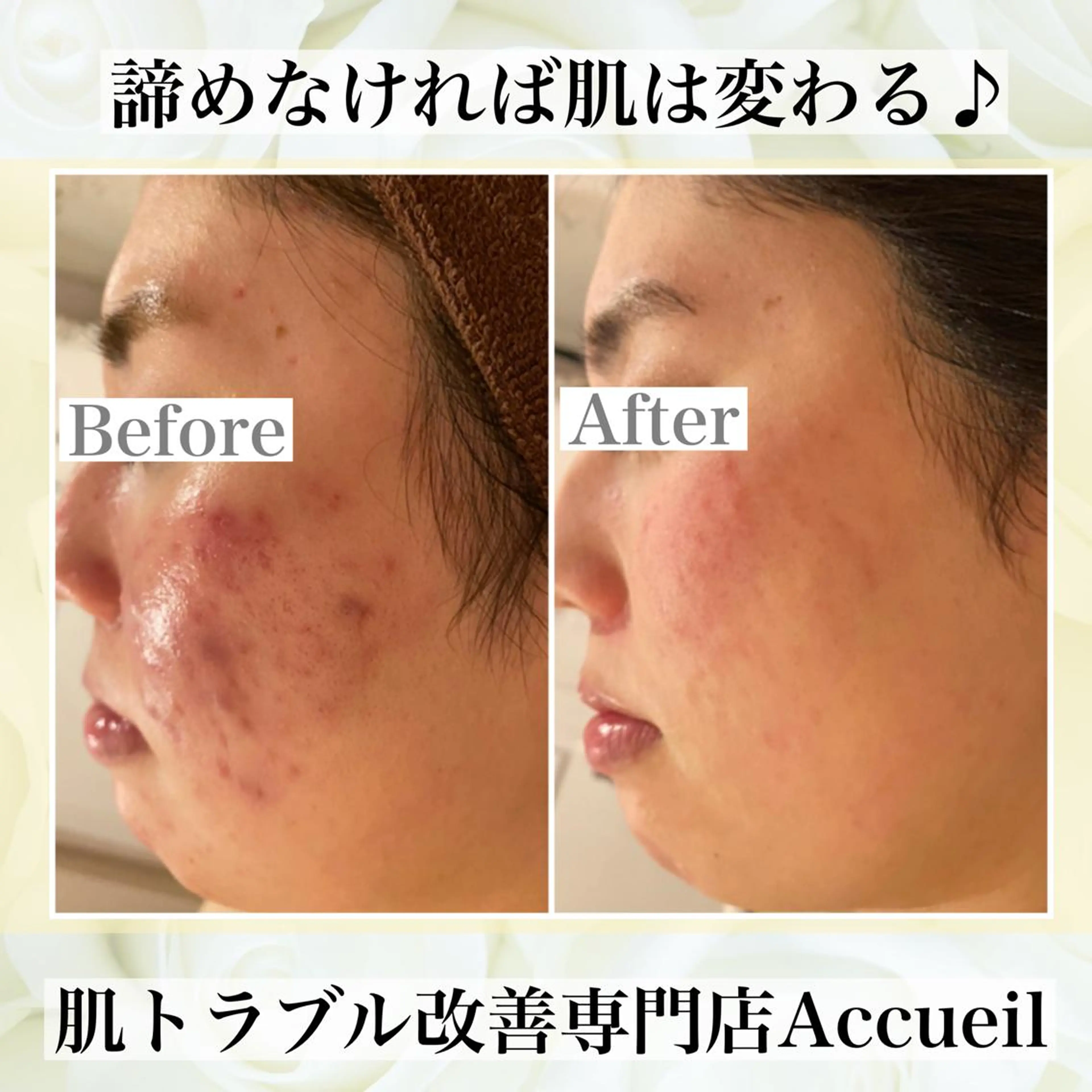 🔥3か月で肌革命 🔥ニキビ専門店のエステ・リラクイメージ