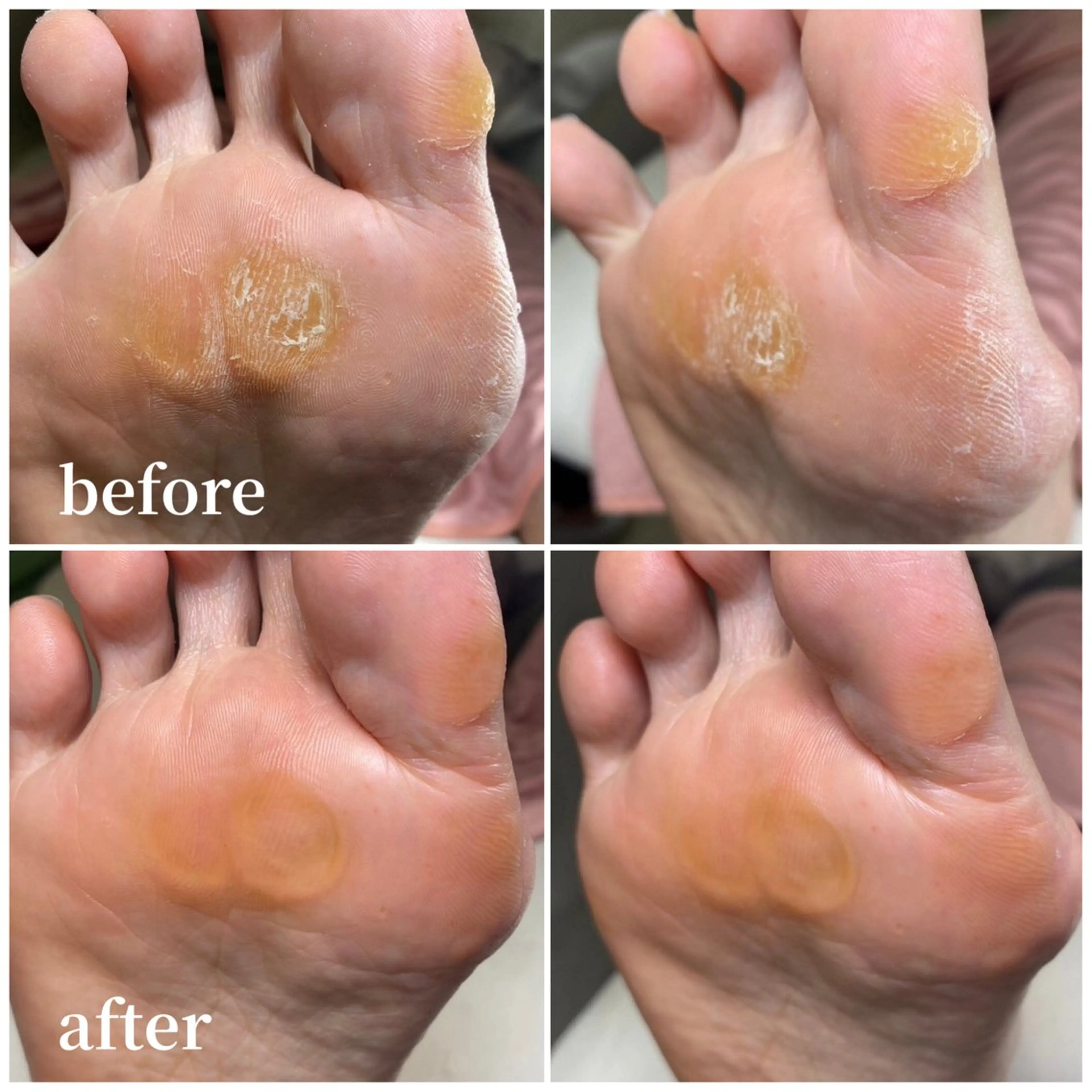 タコ・魚の目含む！足裏すっきり角質ケア🩵歩いても痛みがない足裏へ👣立った時に違いがわかります✨の写真