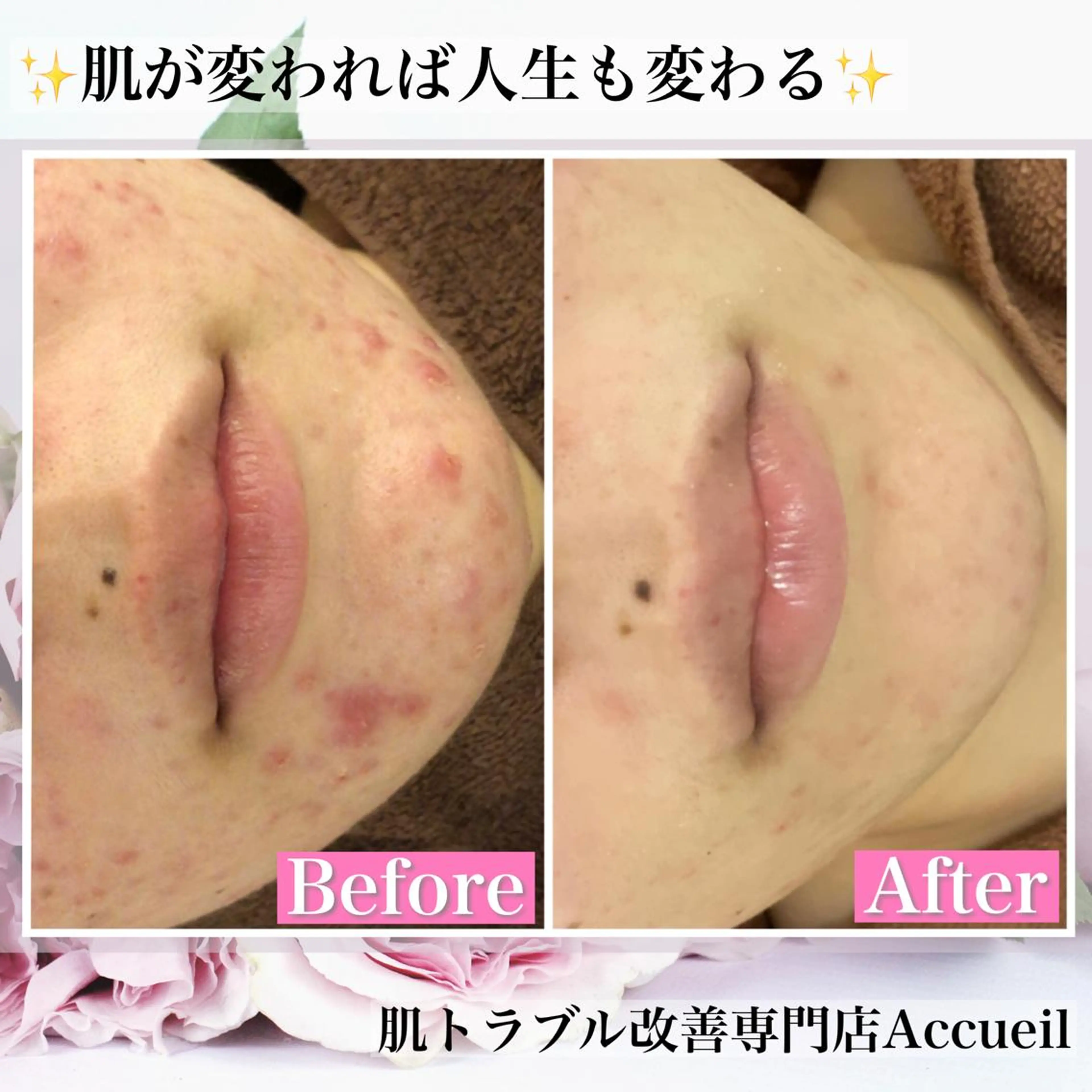 ショート カラー パーマ ヘアアレンジ メンズ キッズ ネイル マツエク・マツパ アイブロウ エステ リラク アクール　齋藤 ♡肌トラブル卒業のエステ・リラクイメージ