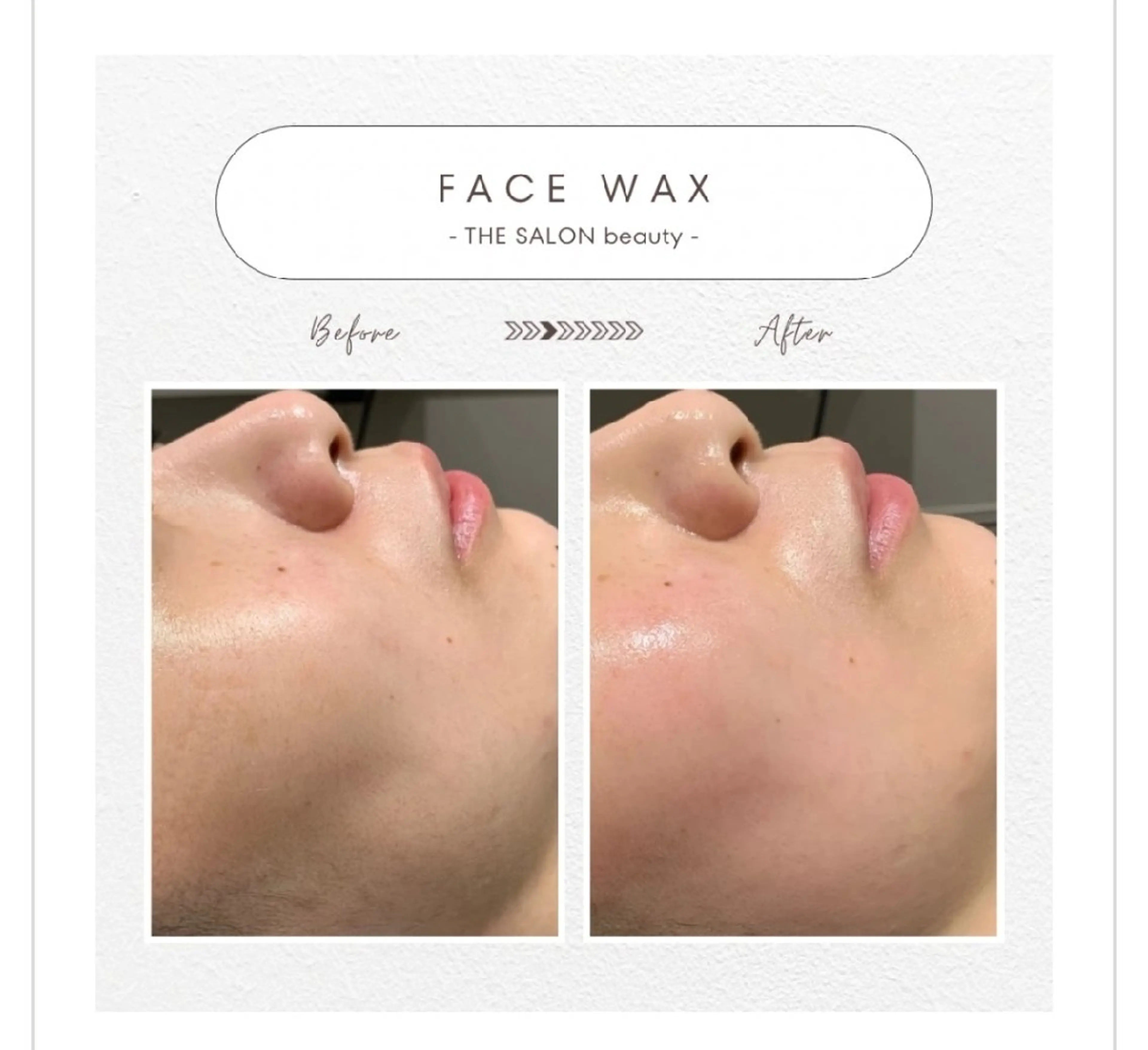 顔WAX脱毛+ハンドフェイシャル（WAX脱毛による産毛除去とオールハンドによるお顔のマッサージ）の写真
