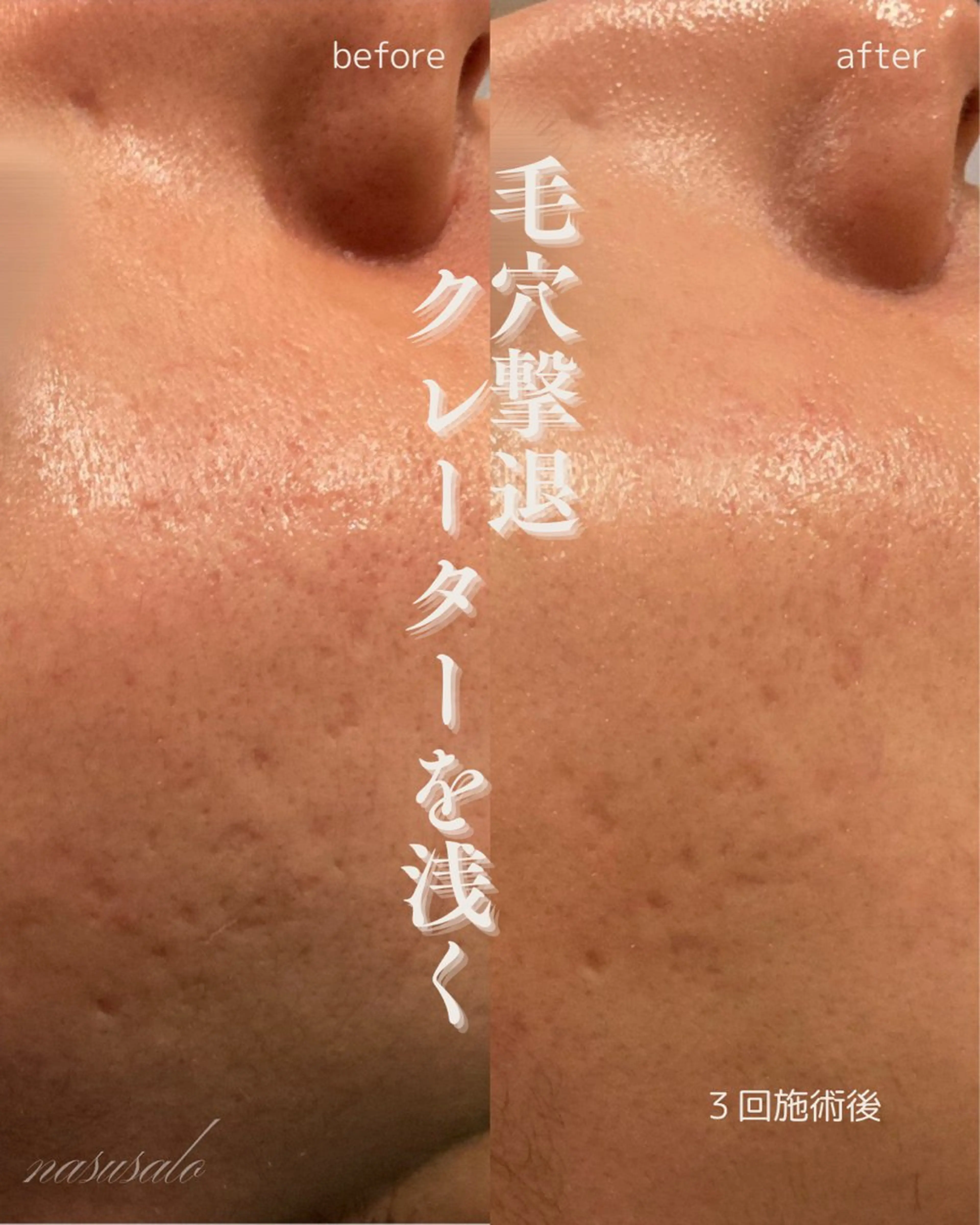エステ 肌育×小顔×毛穴洗浄 ナスサロ 看護師只野のエステ・リラクイメージ