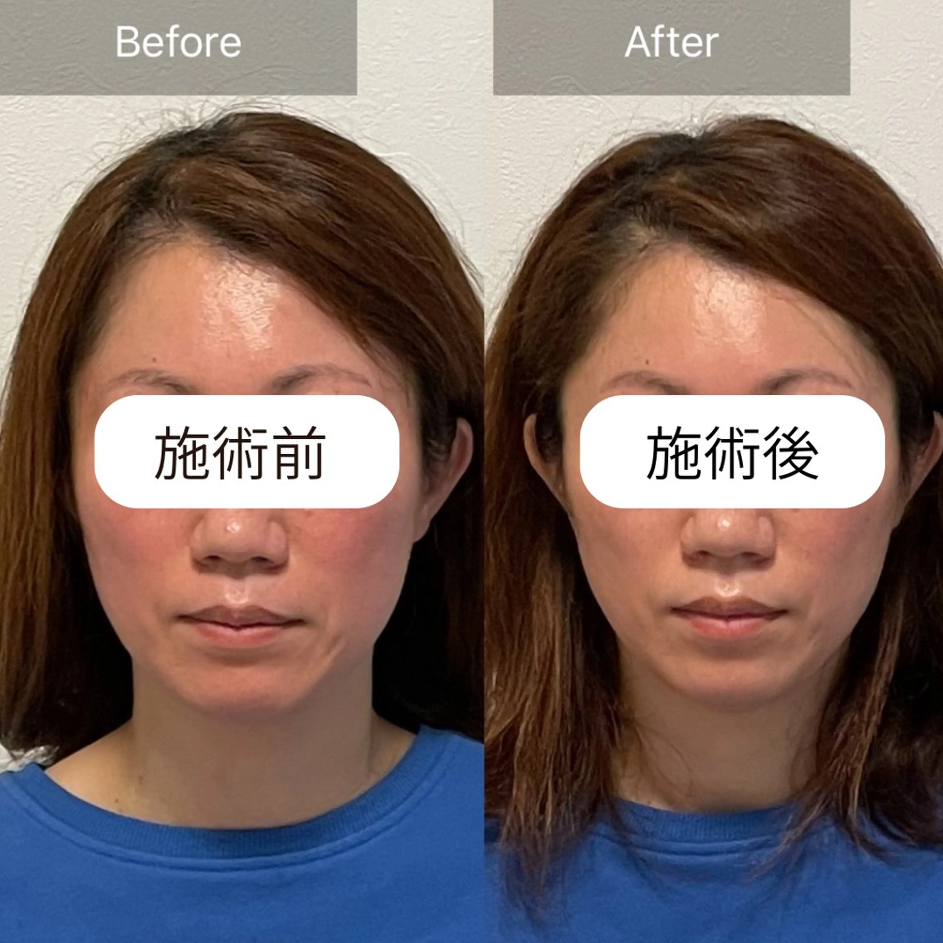 🎀新成人様限定🎀頭蓋骨・小顔矯正の写真