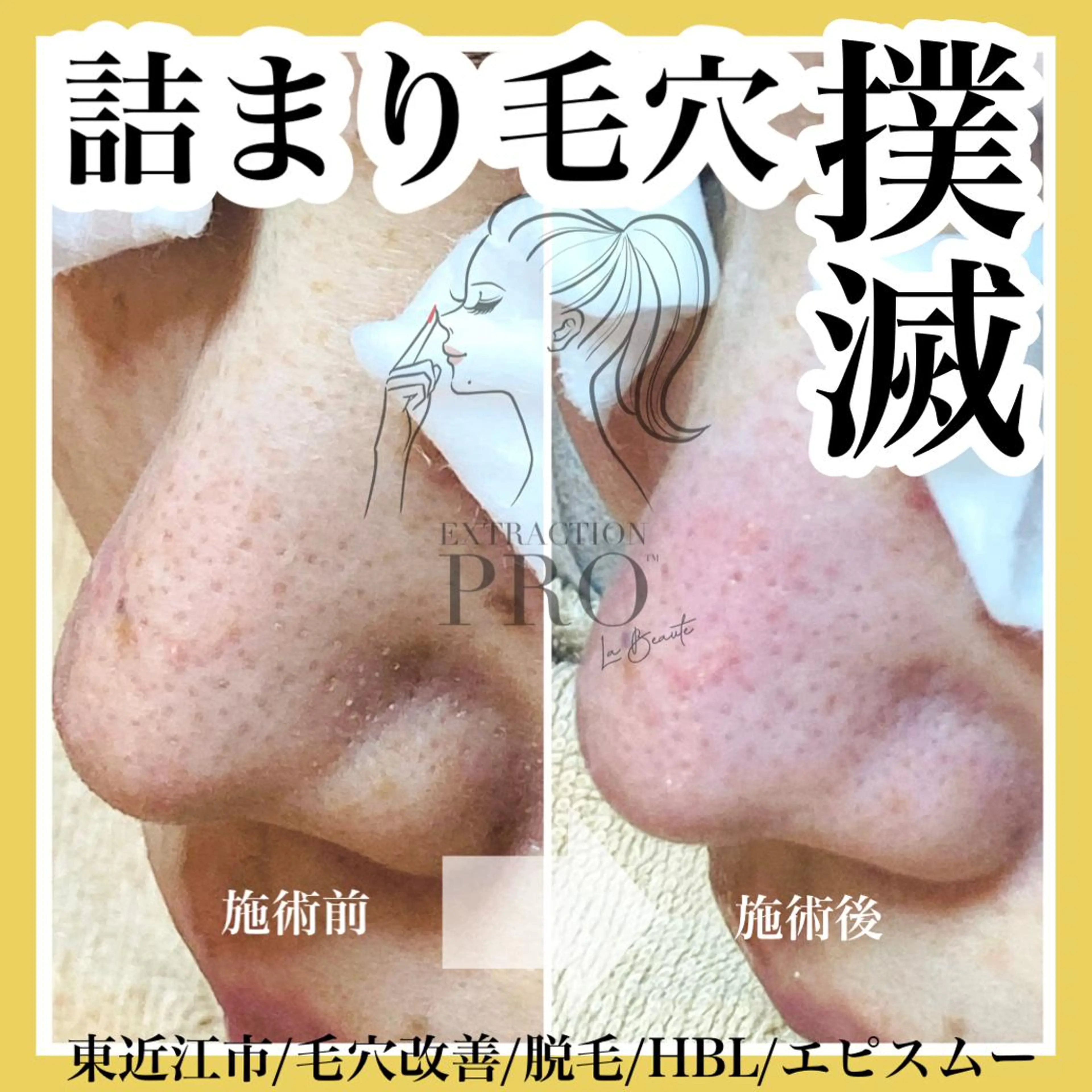 epismoo 脱毛/HBL/毛穴の眉毛・アイブロウイメージ