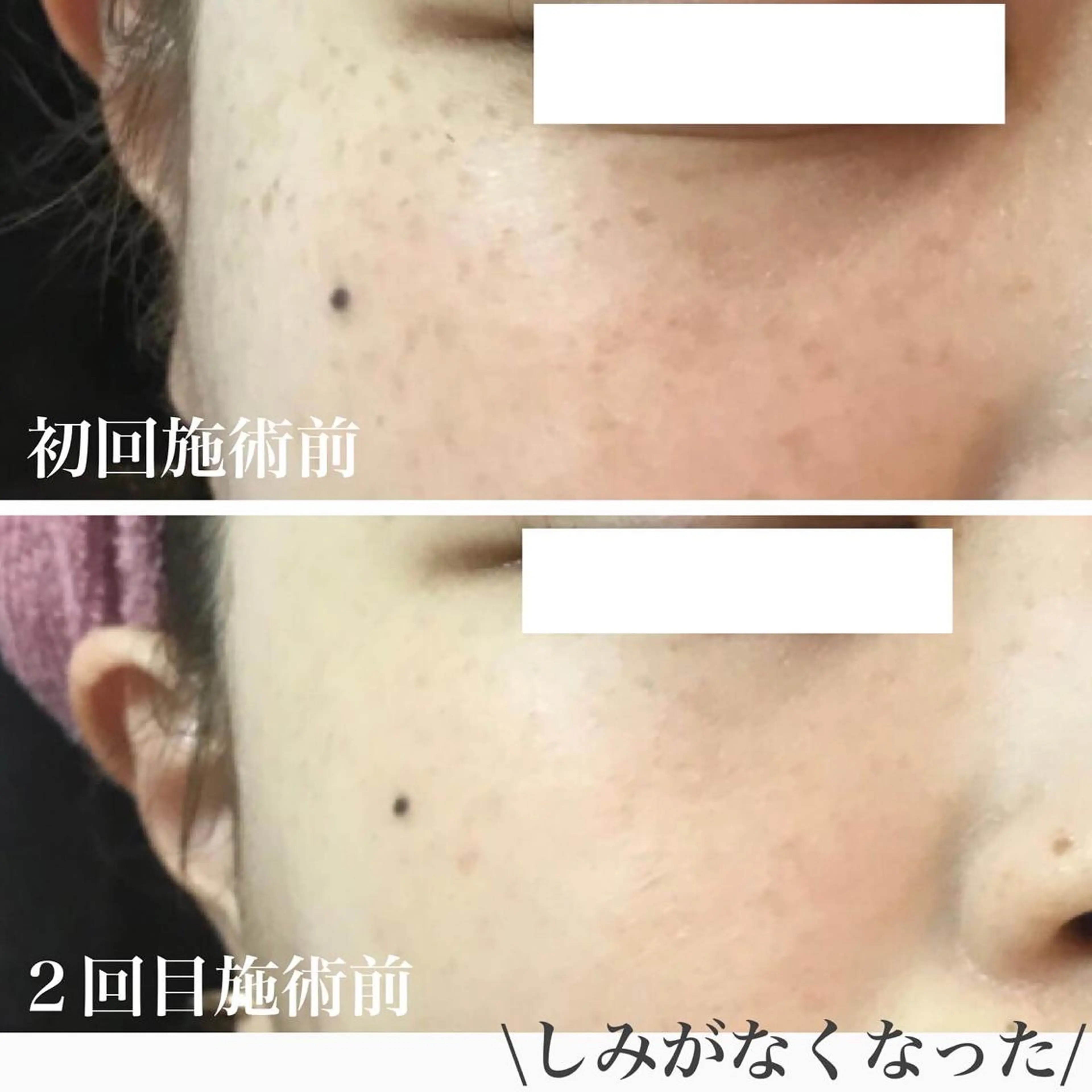 【しみ毛穴専門店】beautysalon Ankh所属・しみ毛穴専門店 Ankh 平田のエステ・リラクイメージ