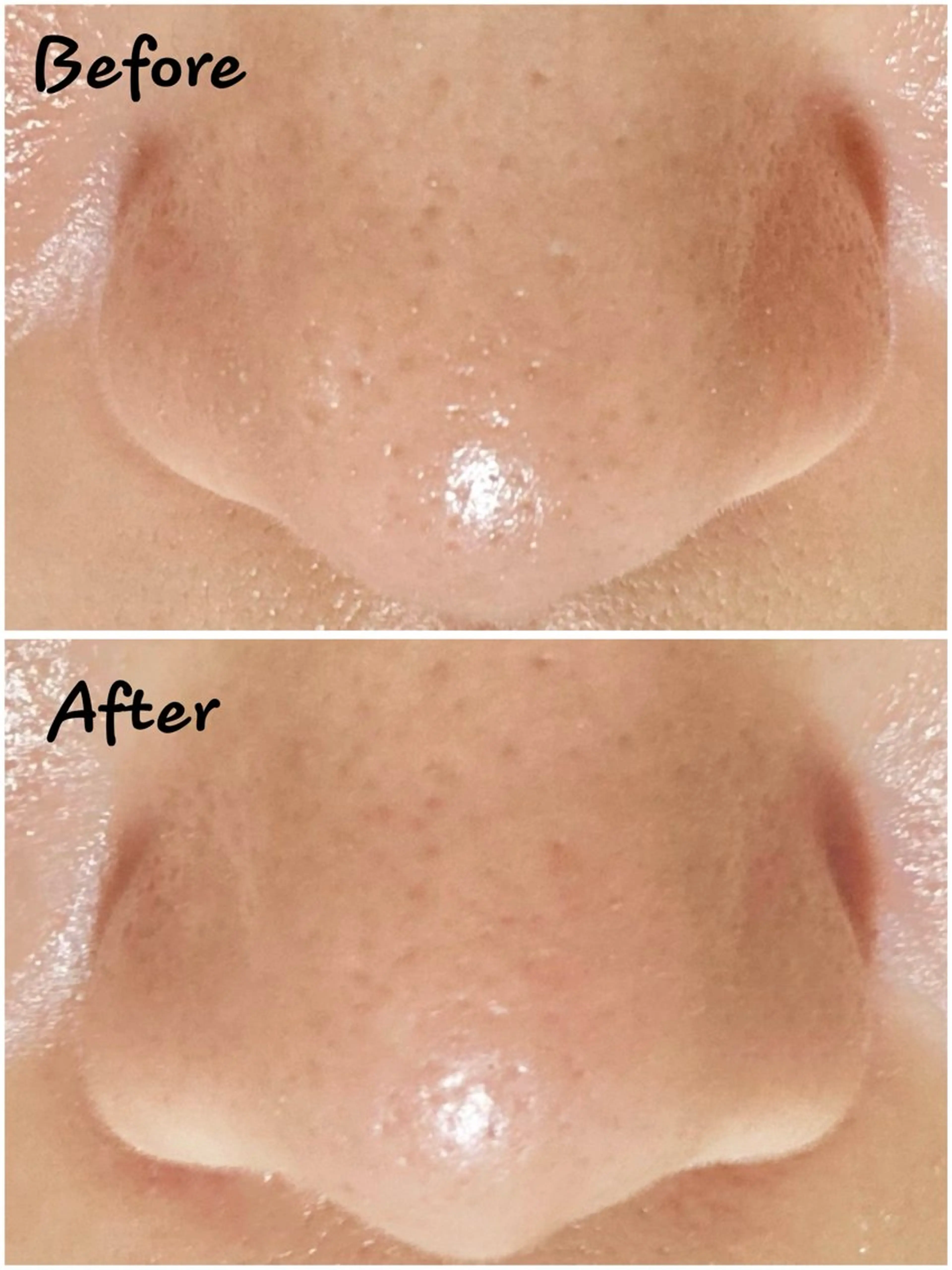 毛穴吸引(鼻+眉間)の写真